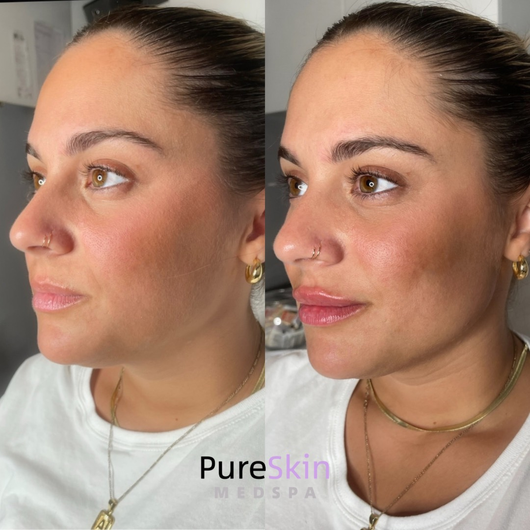  Facial Filler Before and After