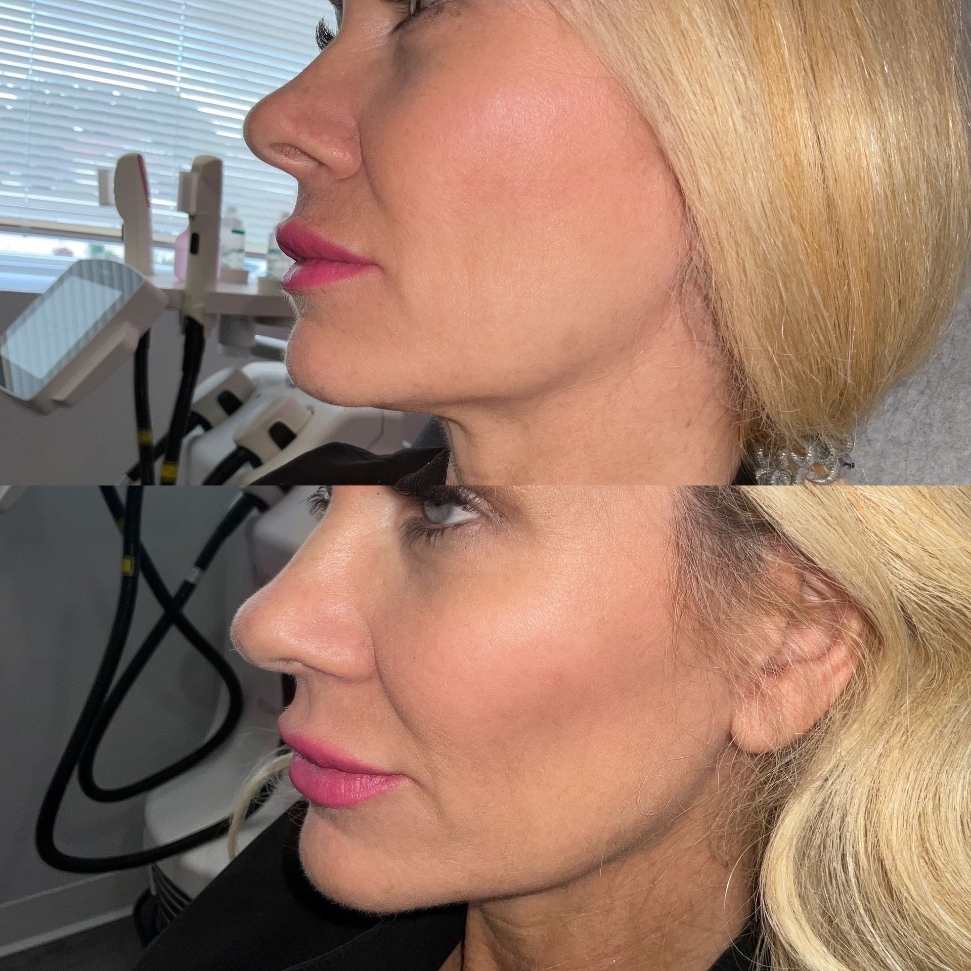  Facial Filler Before and After