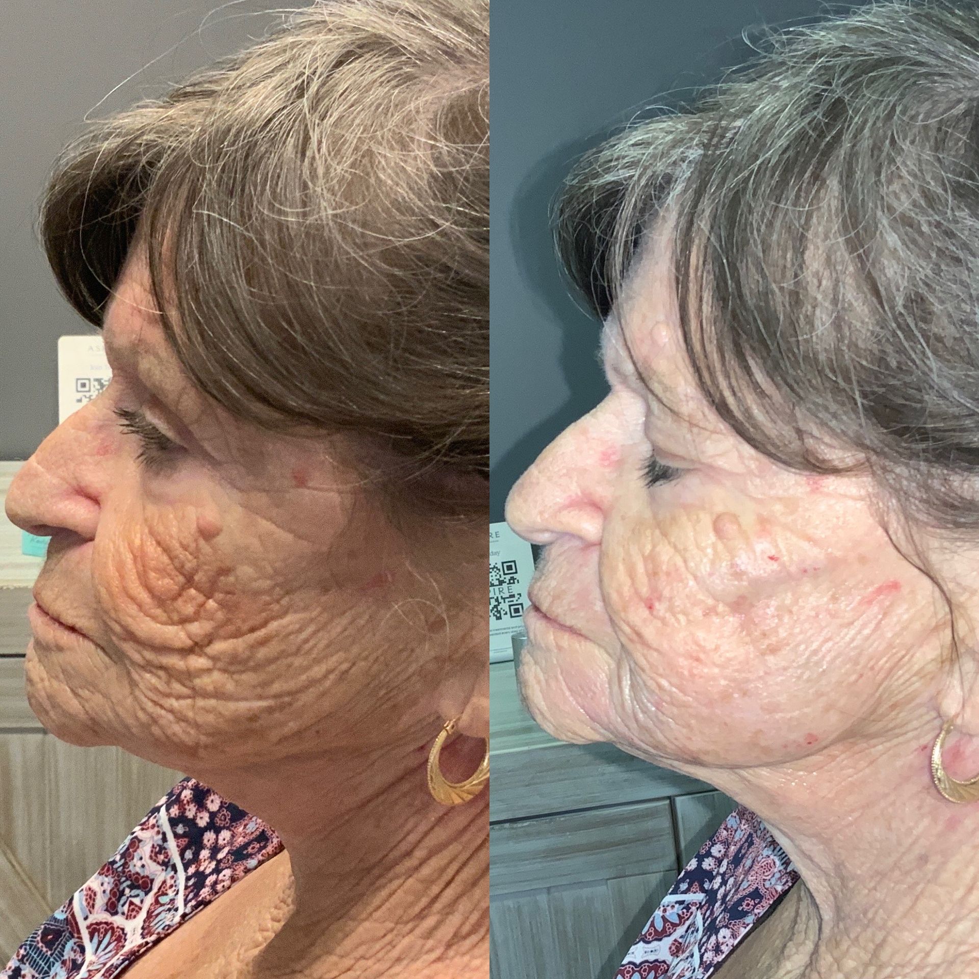  Facial Filler Before and After