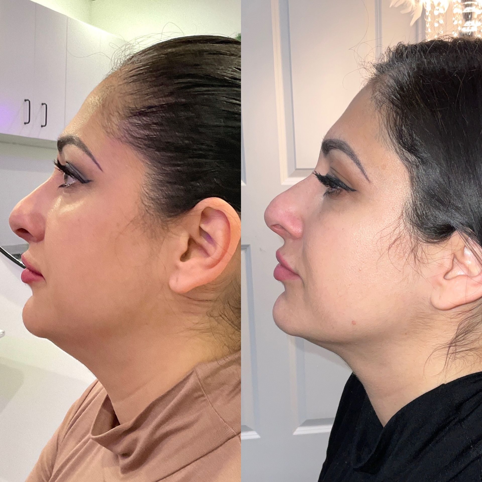 Kybella® Before and After