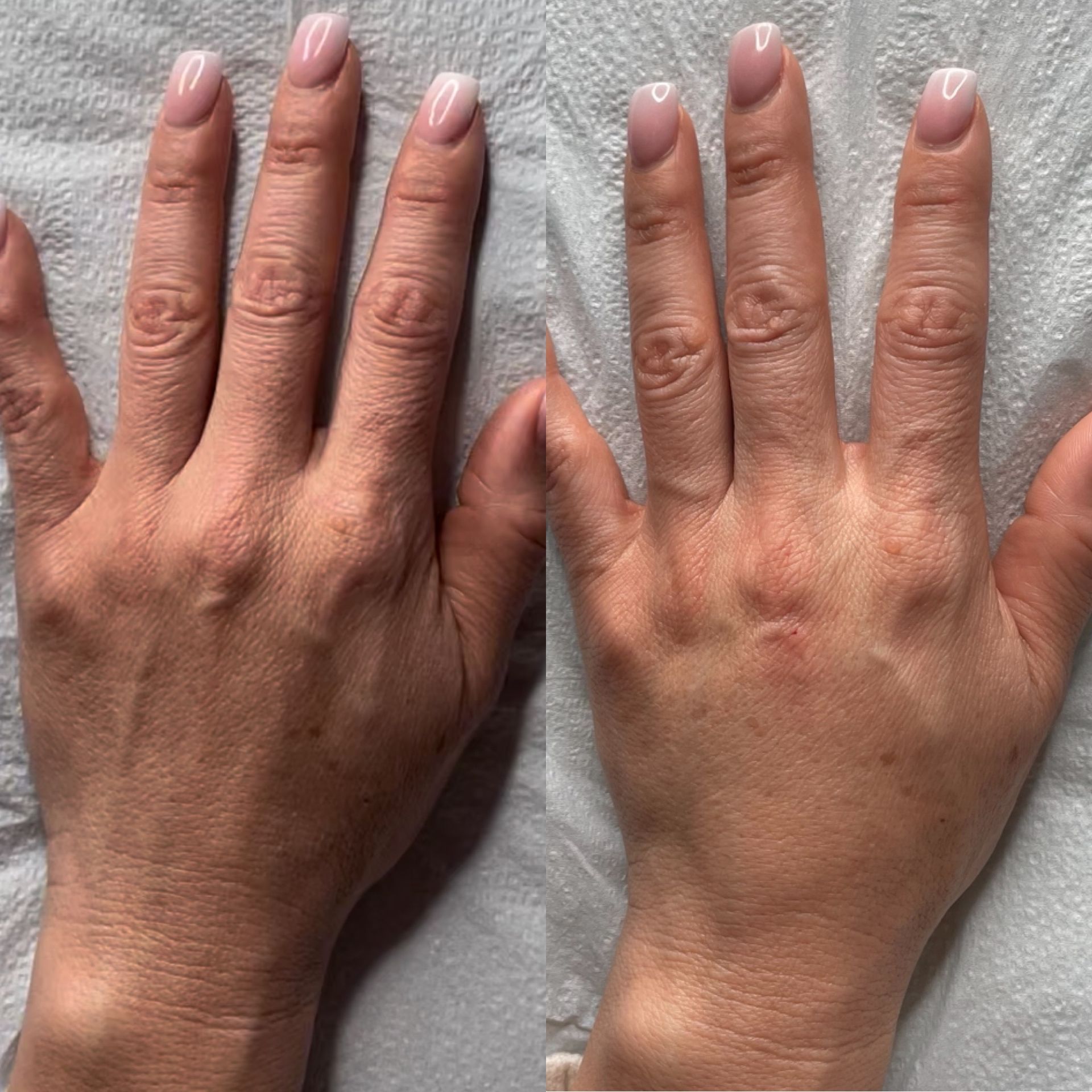 Radiesse Hands Before and After