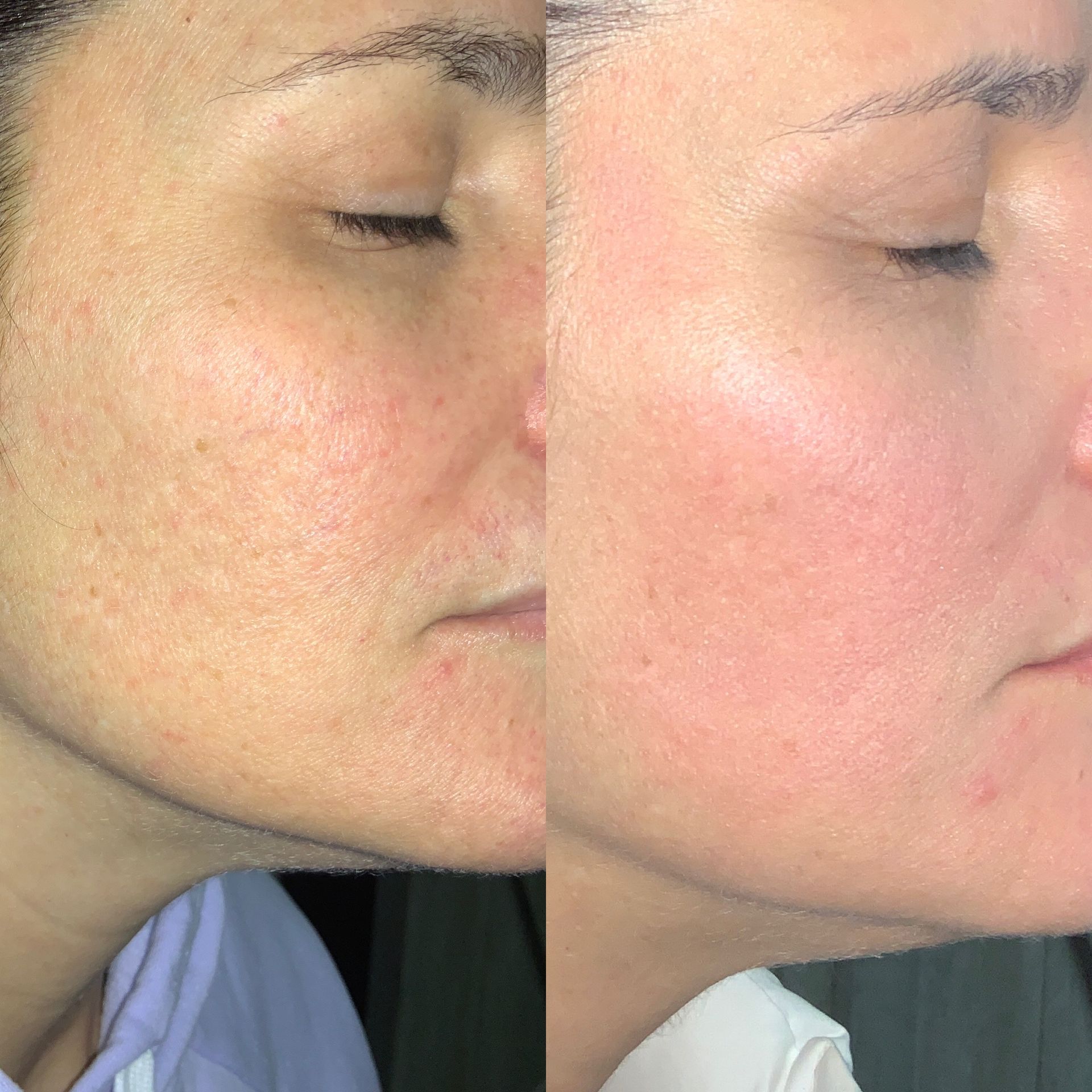 Skin Resurfacing Before and After