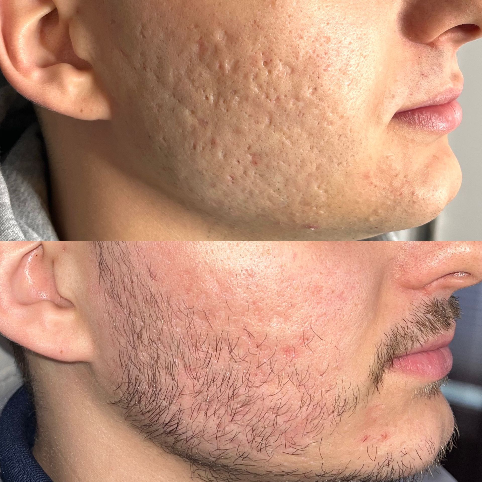 Skin Resurfacing Before and After