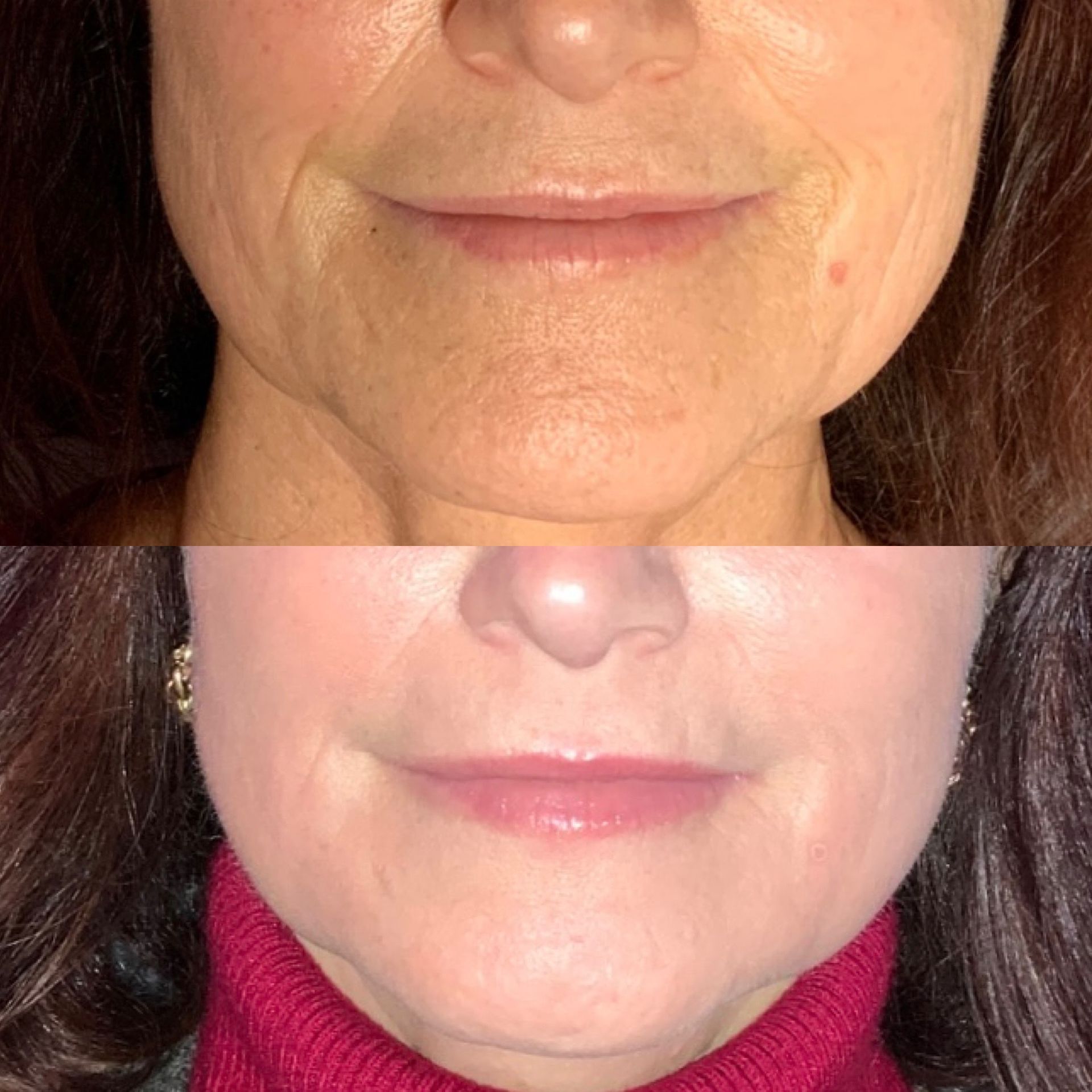 Skin Resurfacing Before and After