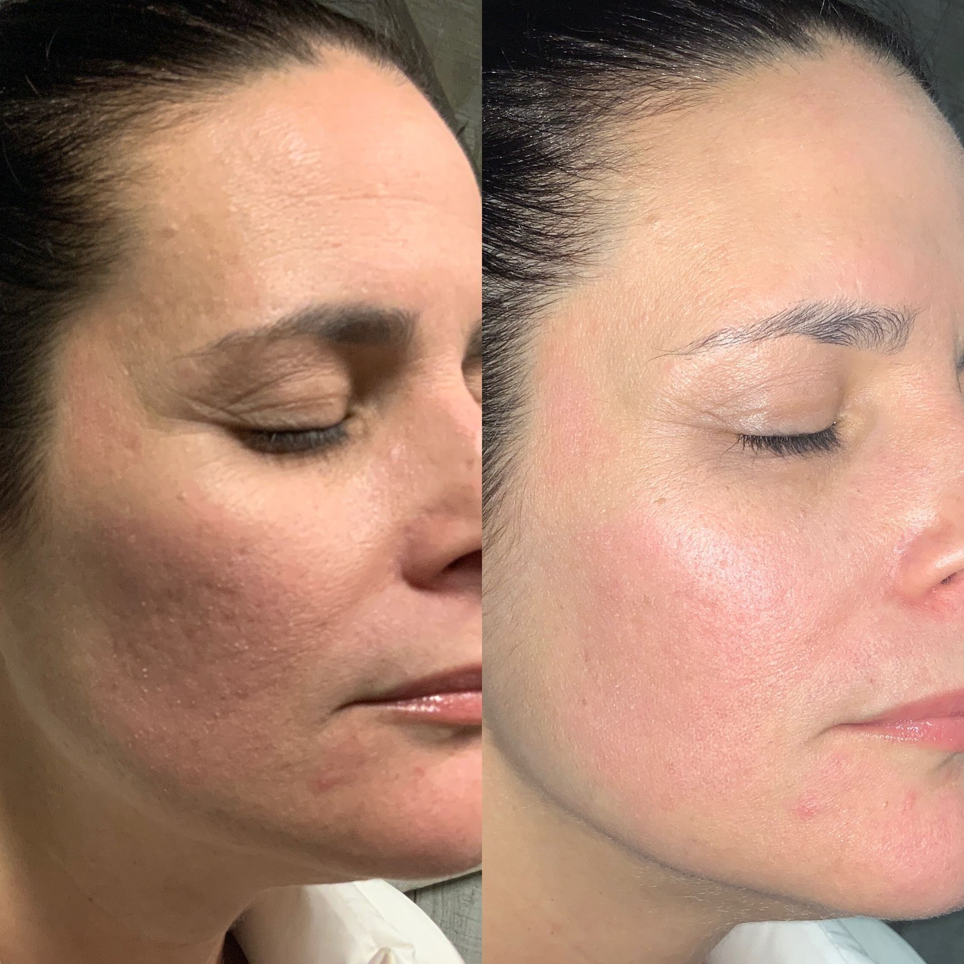 Skin Resurfacing Before and After