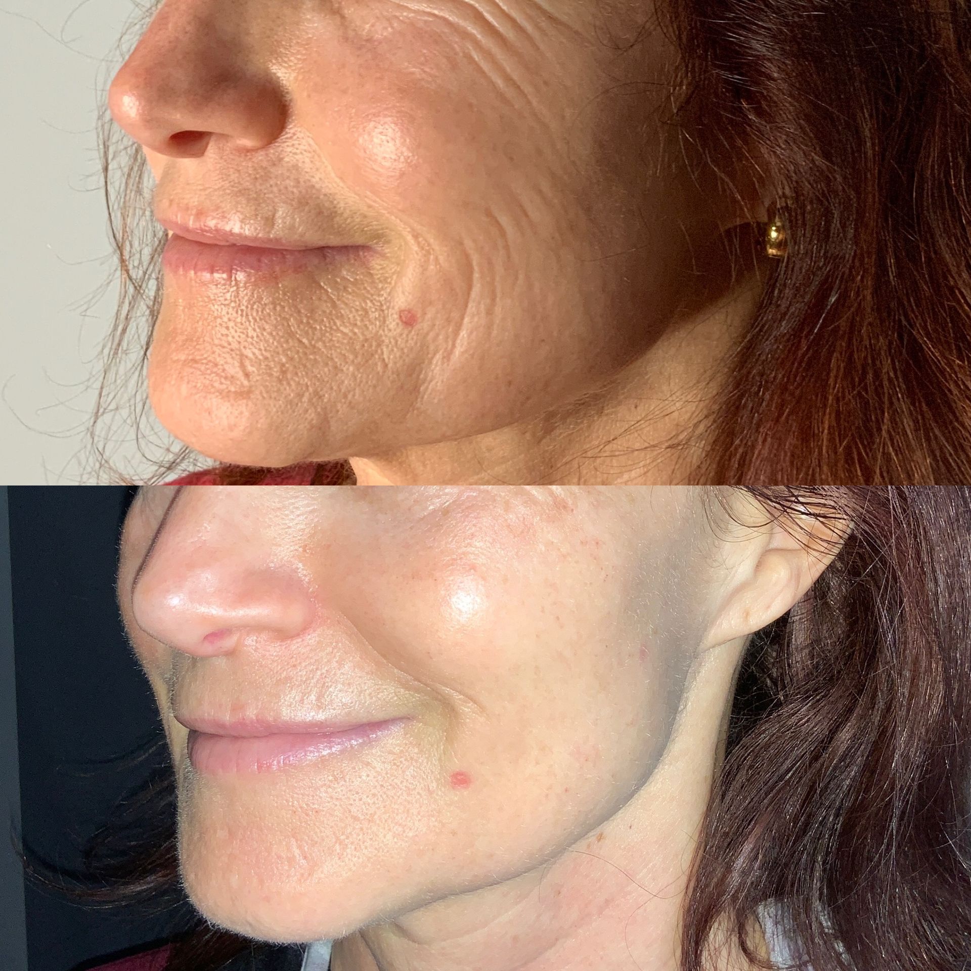 Skin Resurfacing Before and After