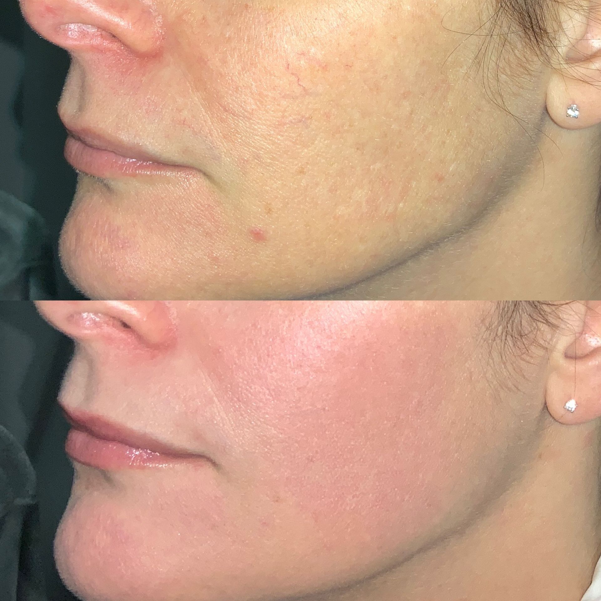 Skin Resurfacing Before and After