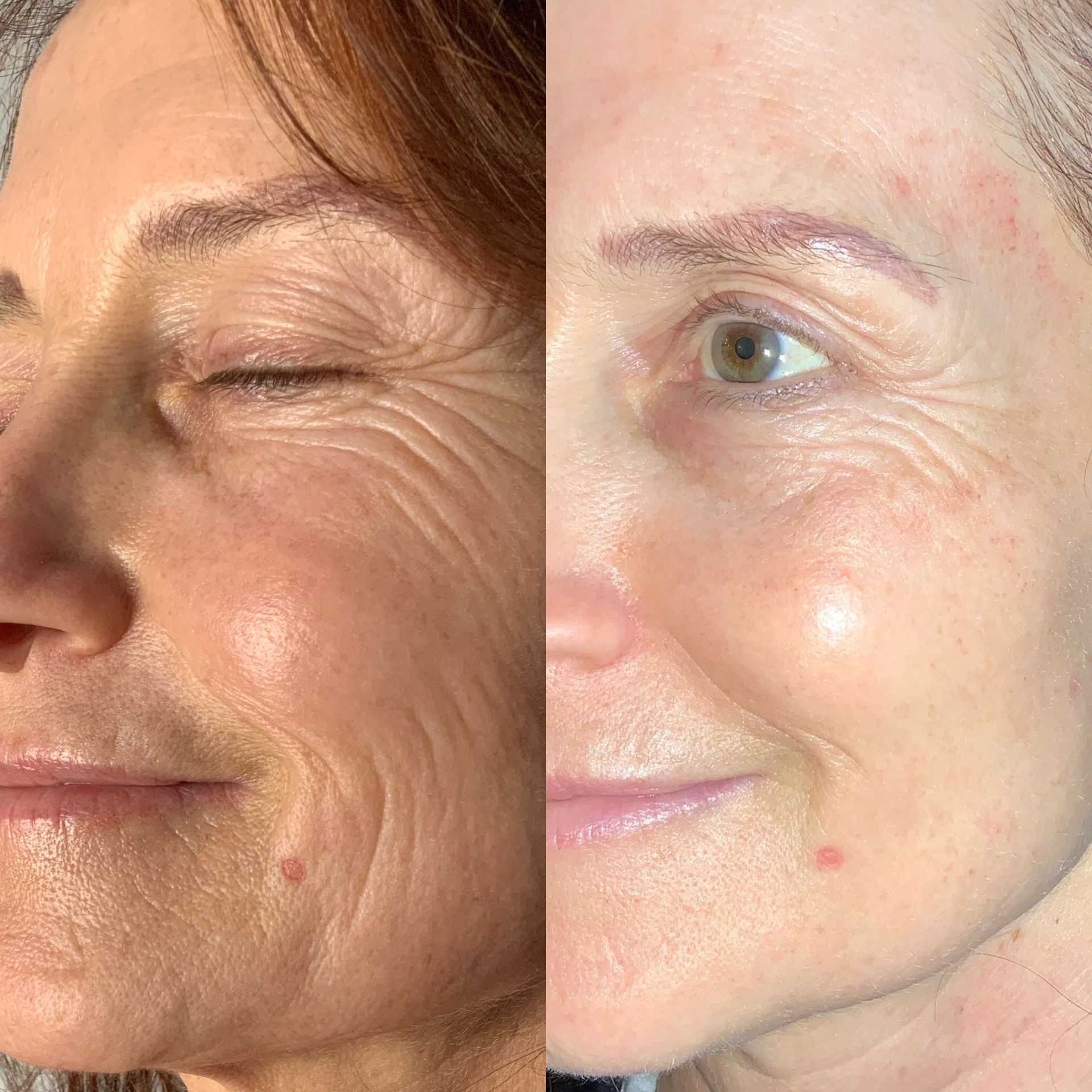 Skin Resurfacing Before and After