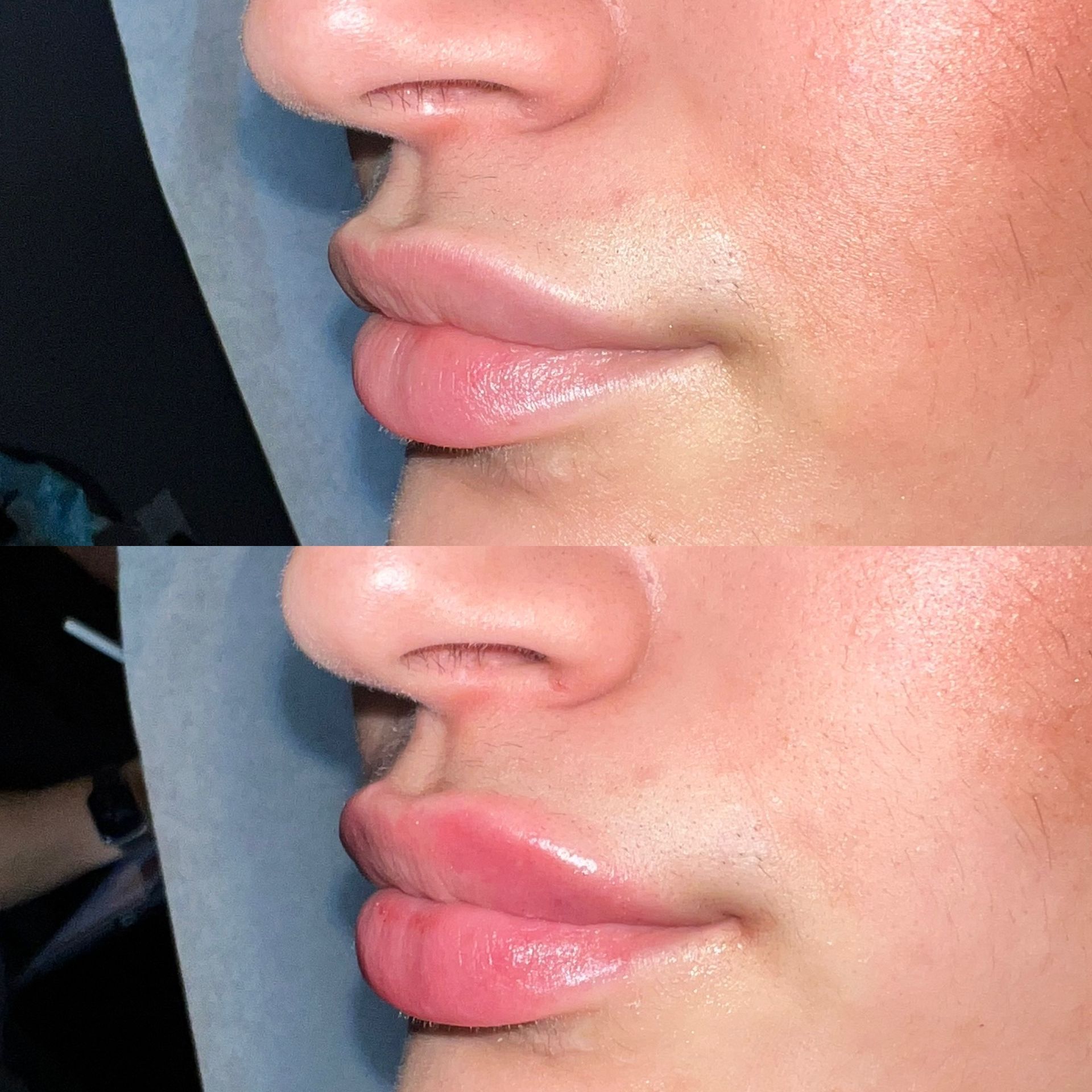 Lip Filler Before and After