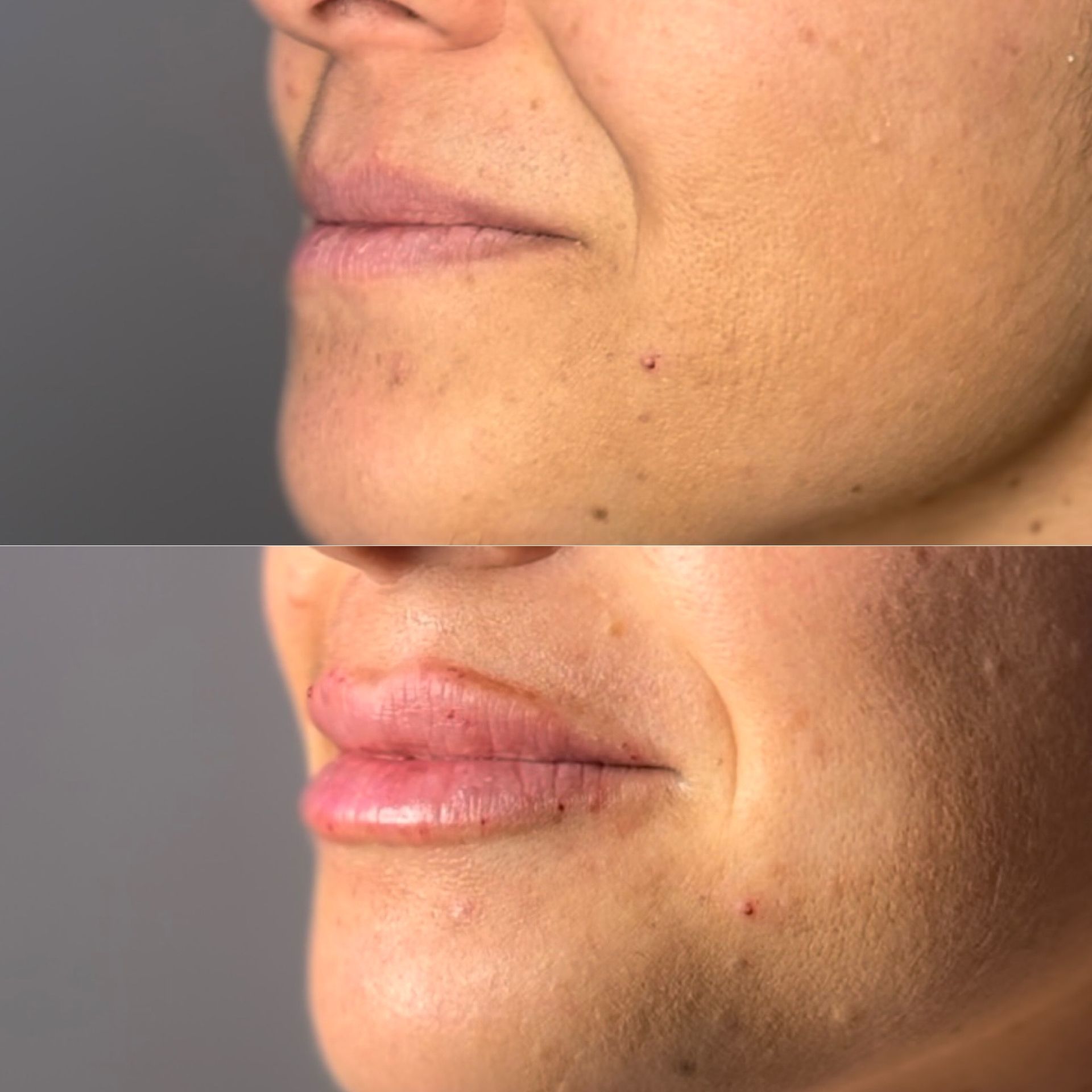 Lip Filler Before and After