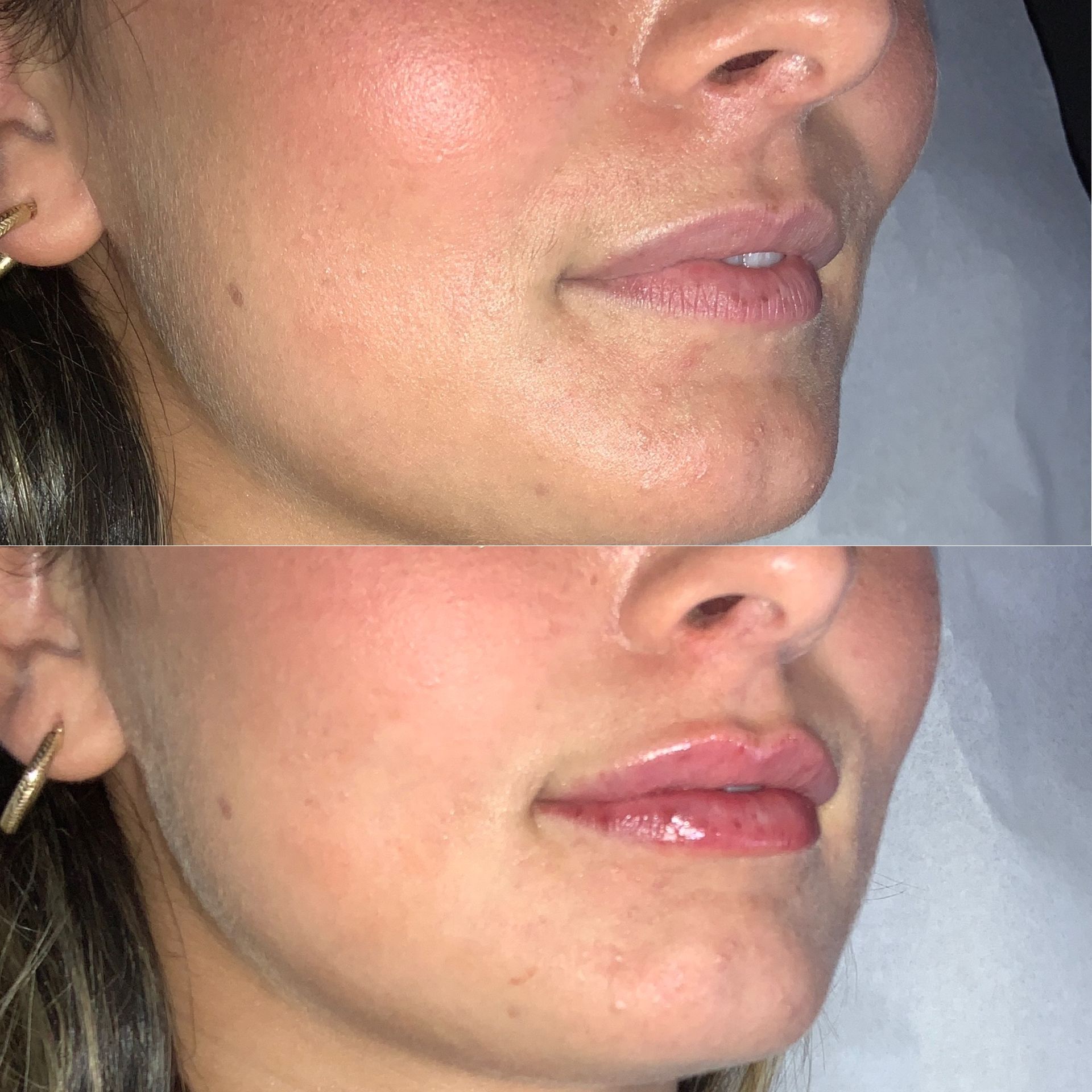 Lip Filler Before and After