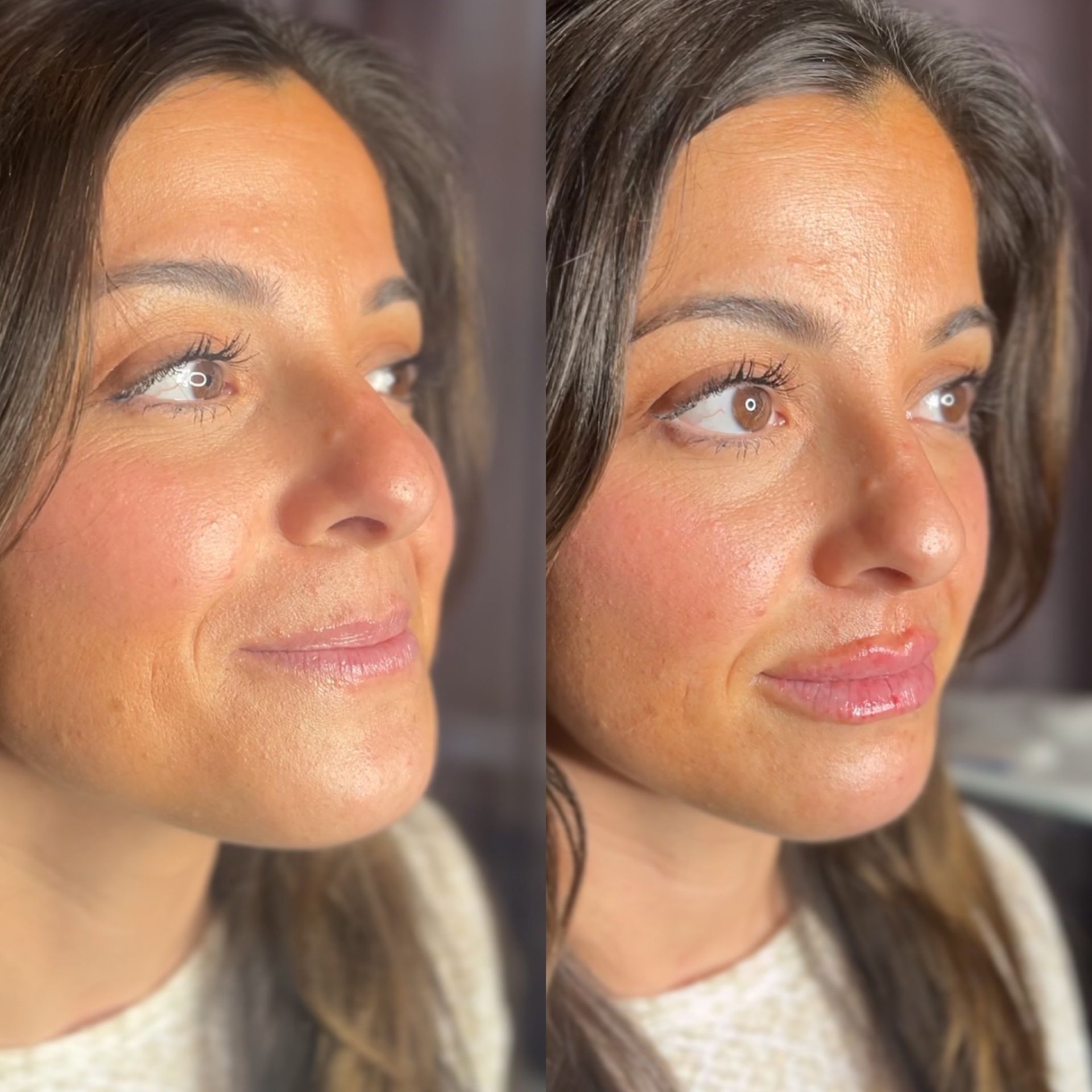 Lip Filler Before and After