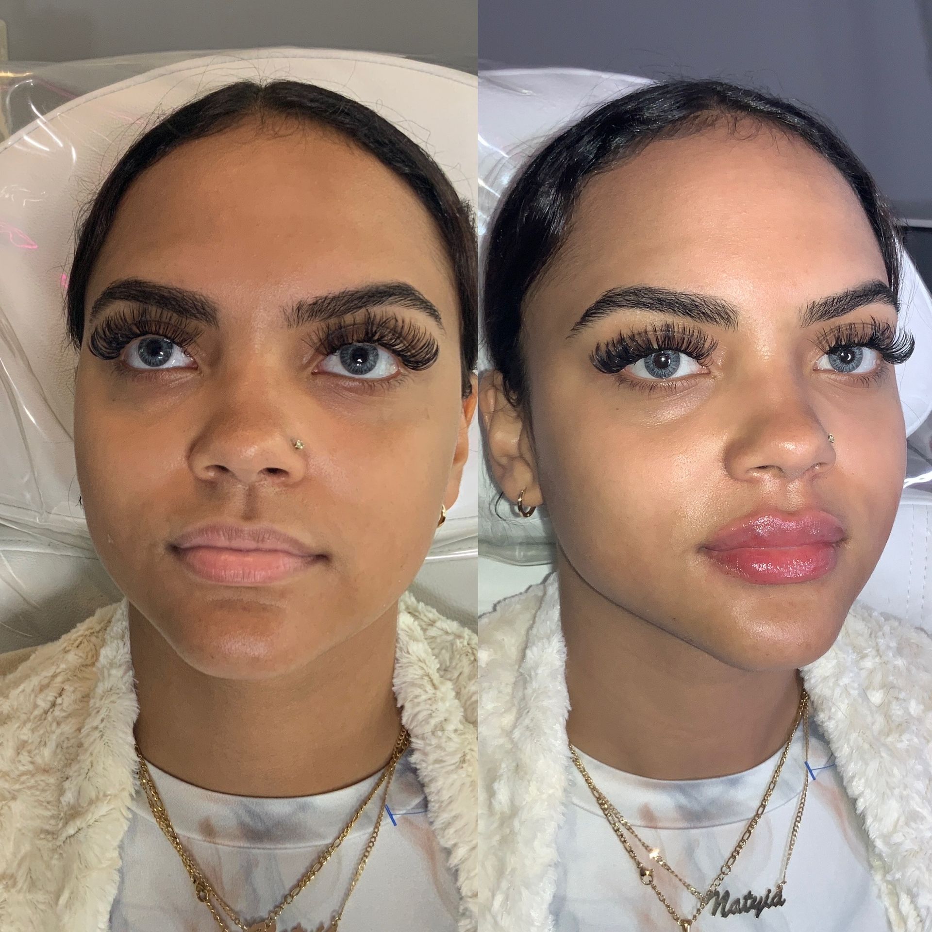 Lip Filler Before and After