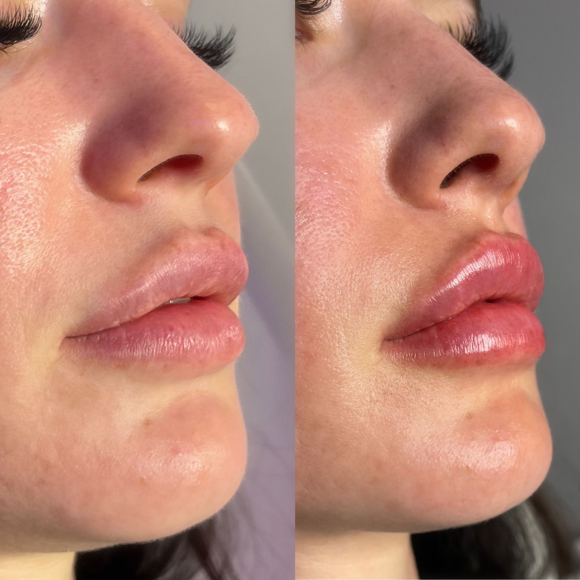 Lip Filler Before and After