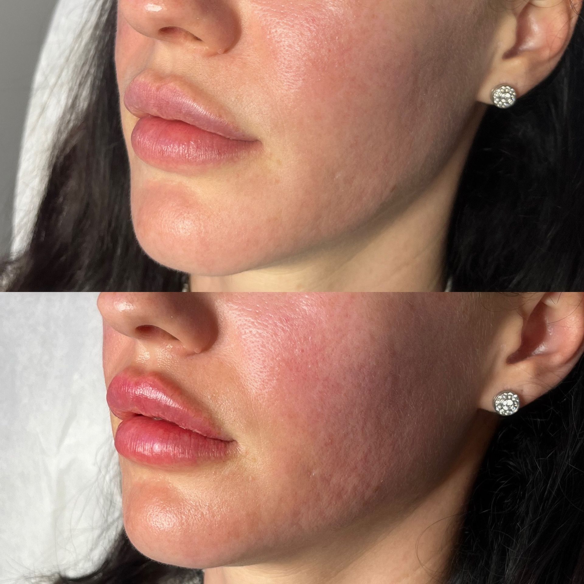 Lip Filler Before and After