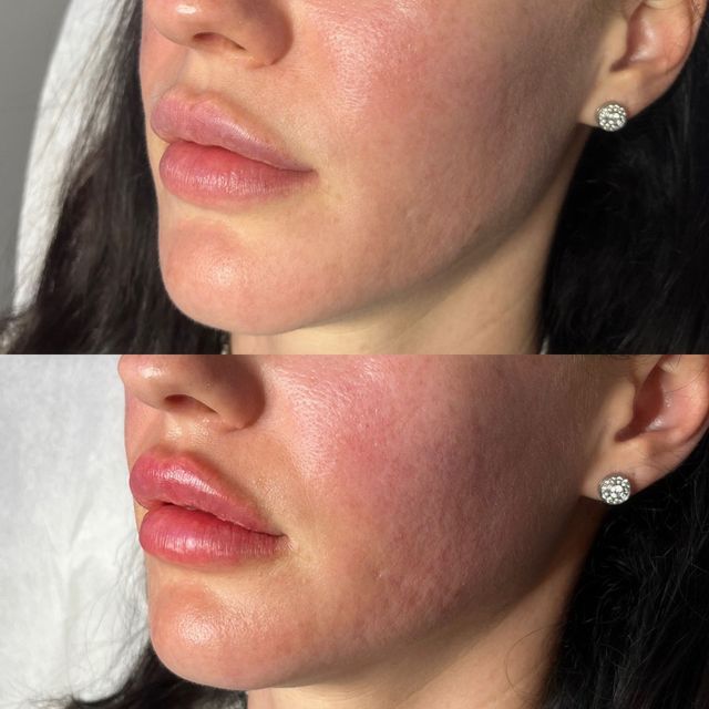 lip filler new haven c Lip Fillers in CT - Pure Skin MedSpa - New Haven County CT