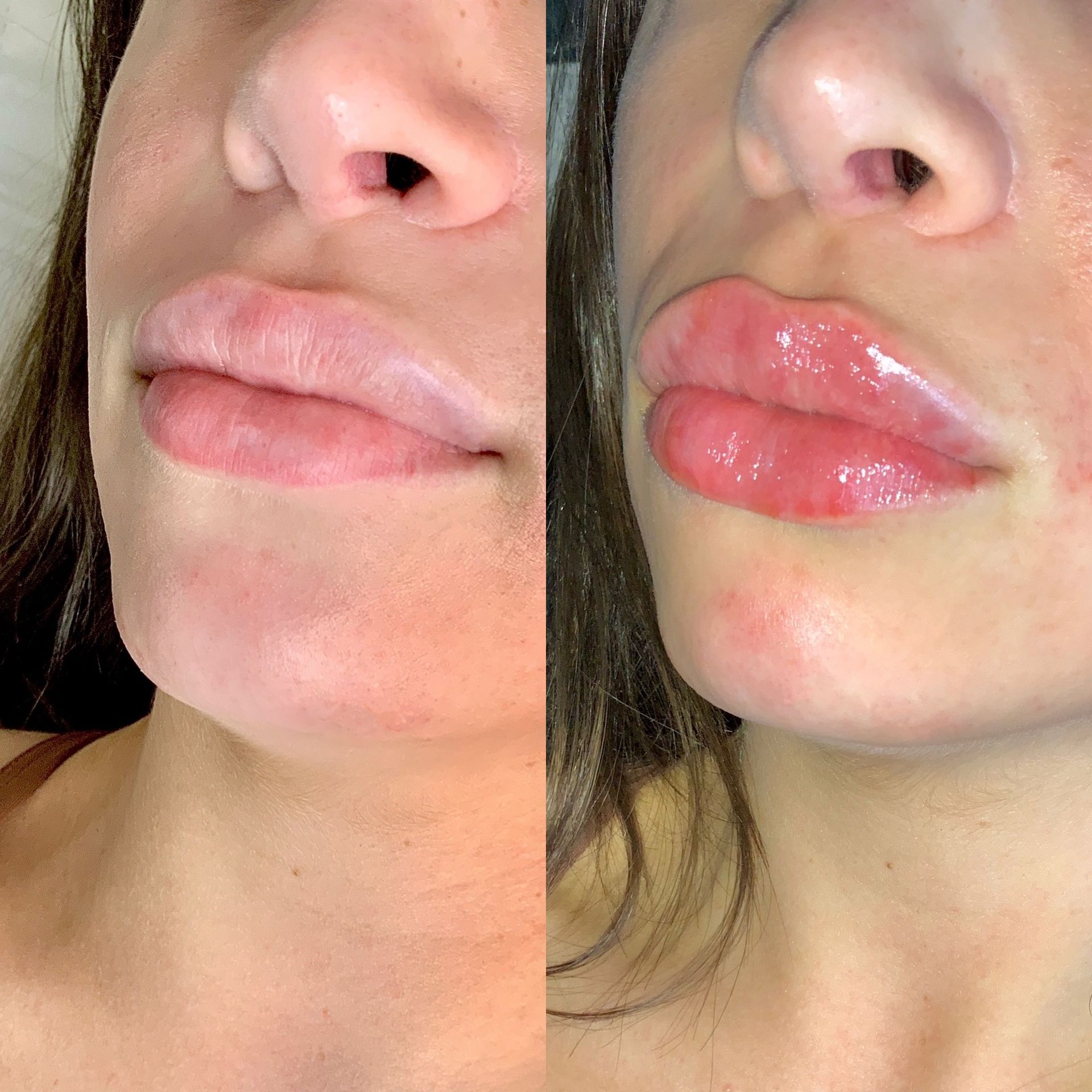 Lip Filler Before and After