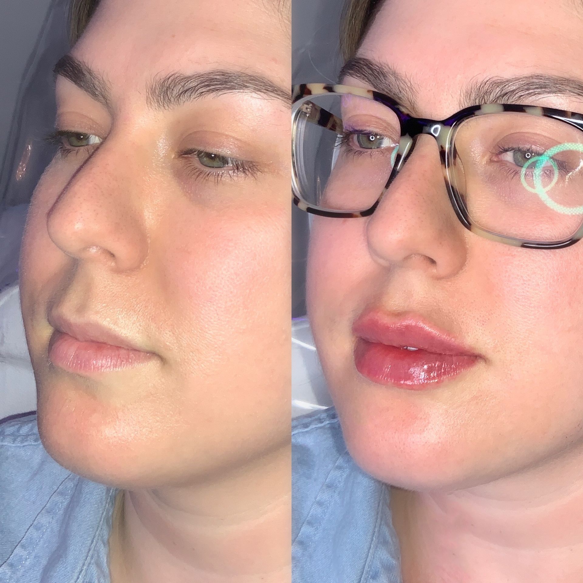 Lip Filler Before and After