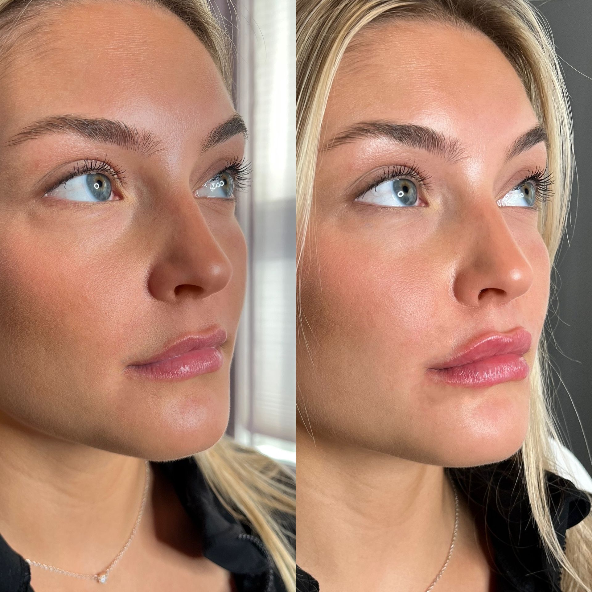 Lip Filler Before and After