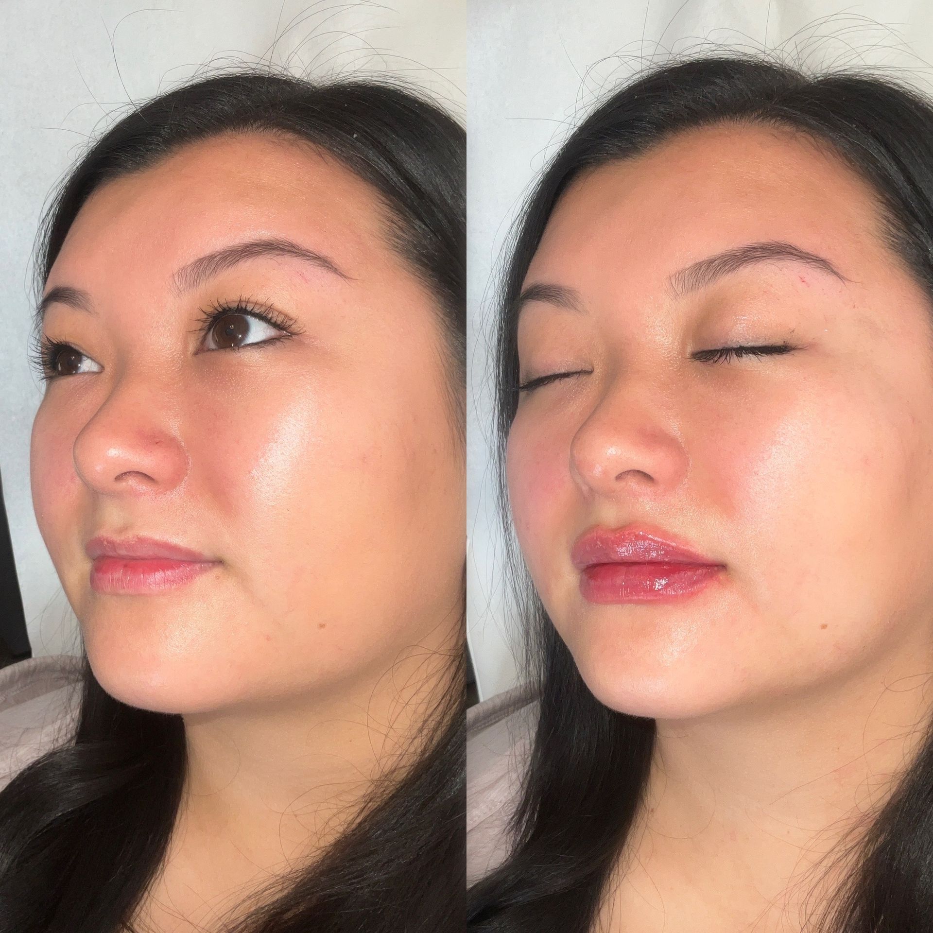 Lip Filler Before and After