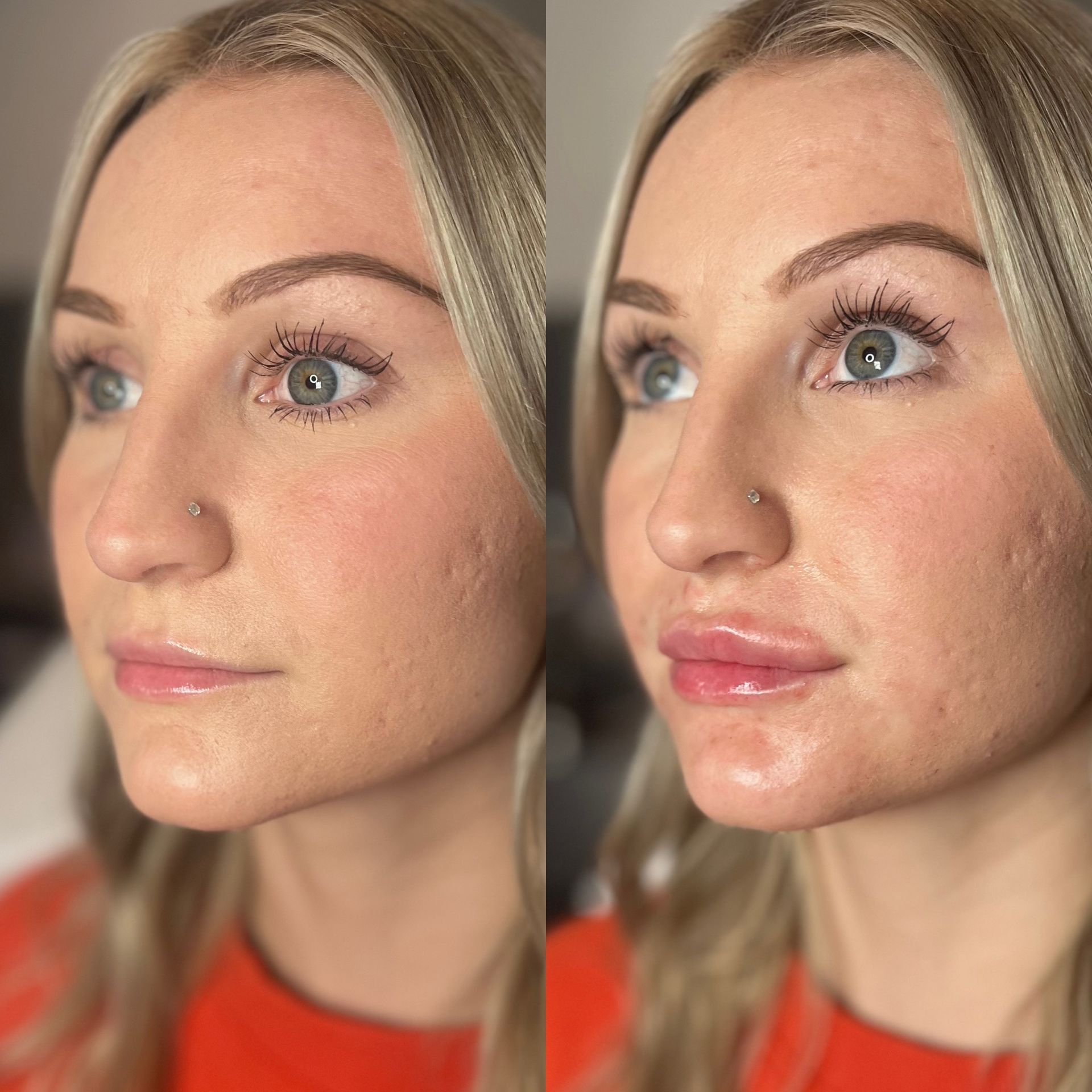 Lip Filler Before and After