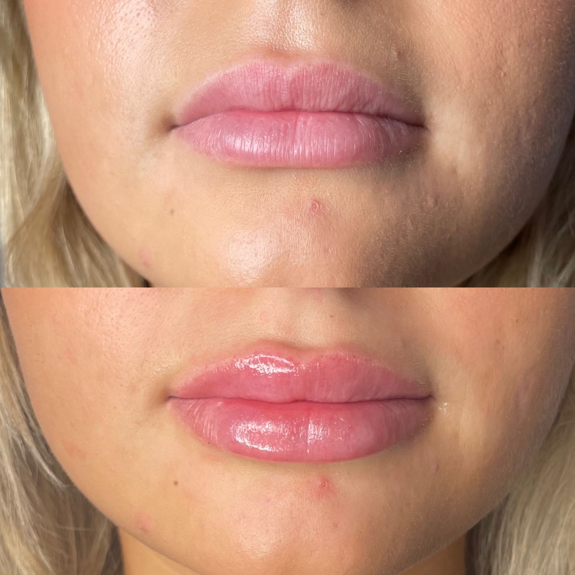 Lip Filler Before and After