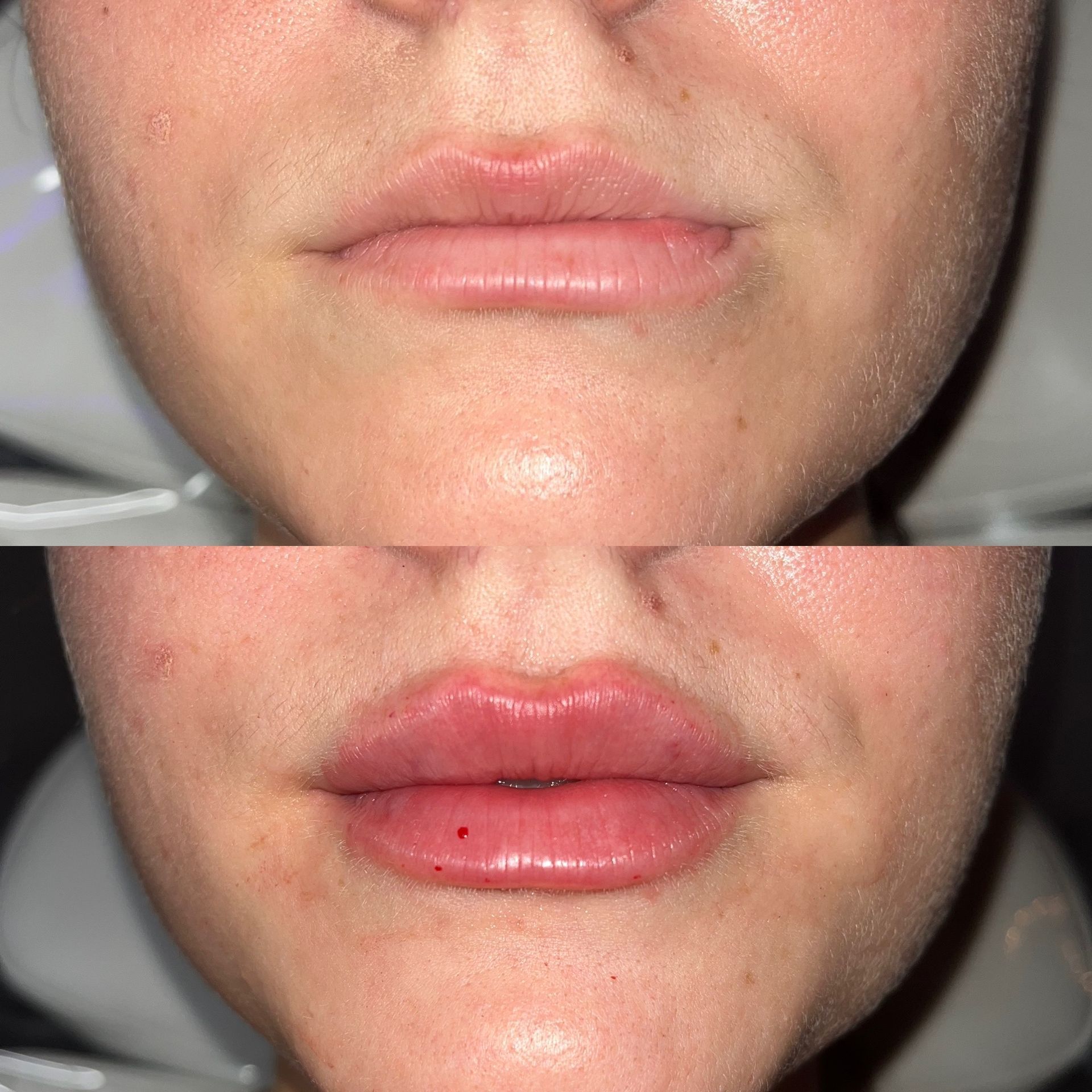 Lip Filler Before and After