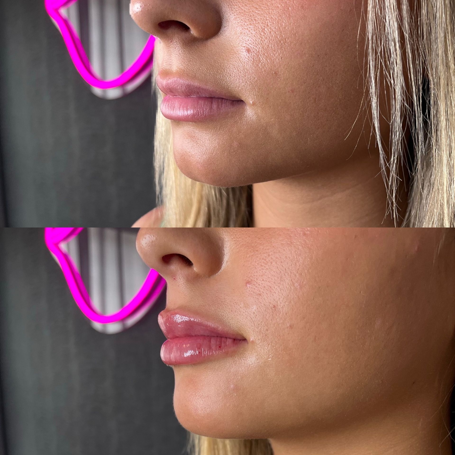 Lip Filler Before and After