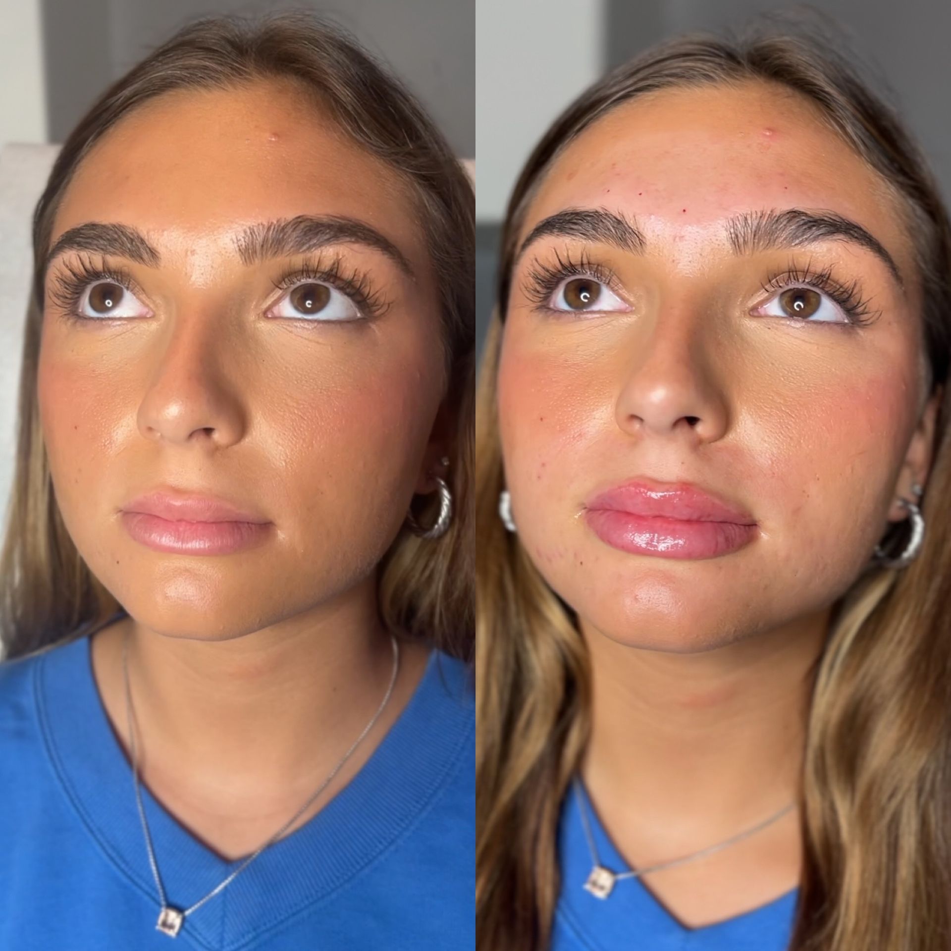 Lip Filler Before and After