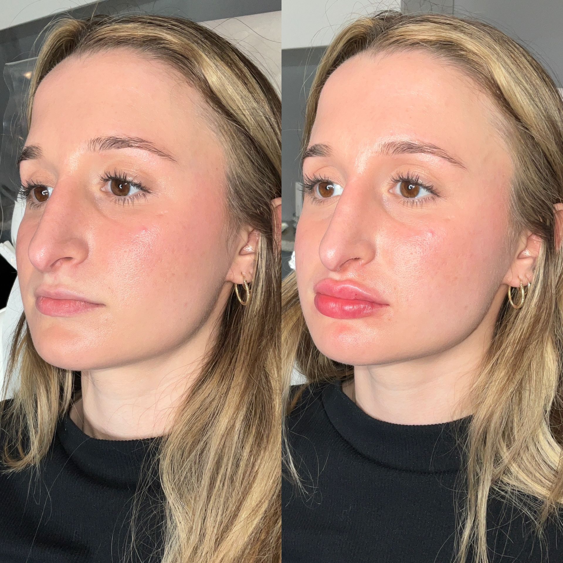 Lip Filler Before and After