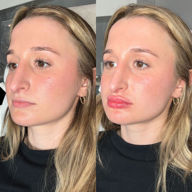 lip filler new haven c Lip Fillers in CT - Pure Skin MedSpa - New Haven County CT