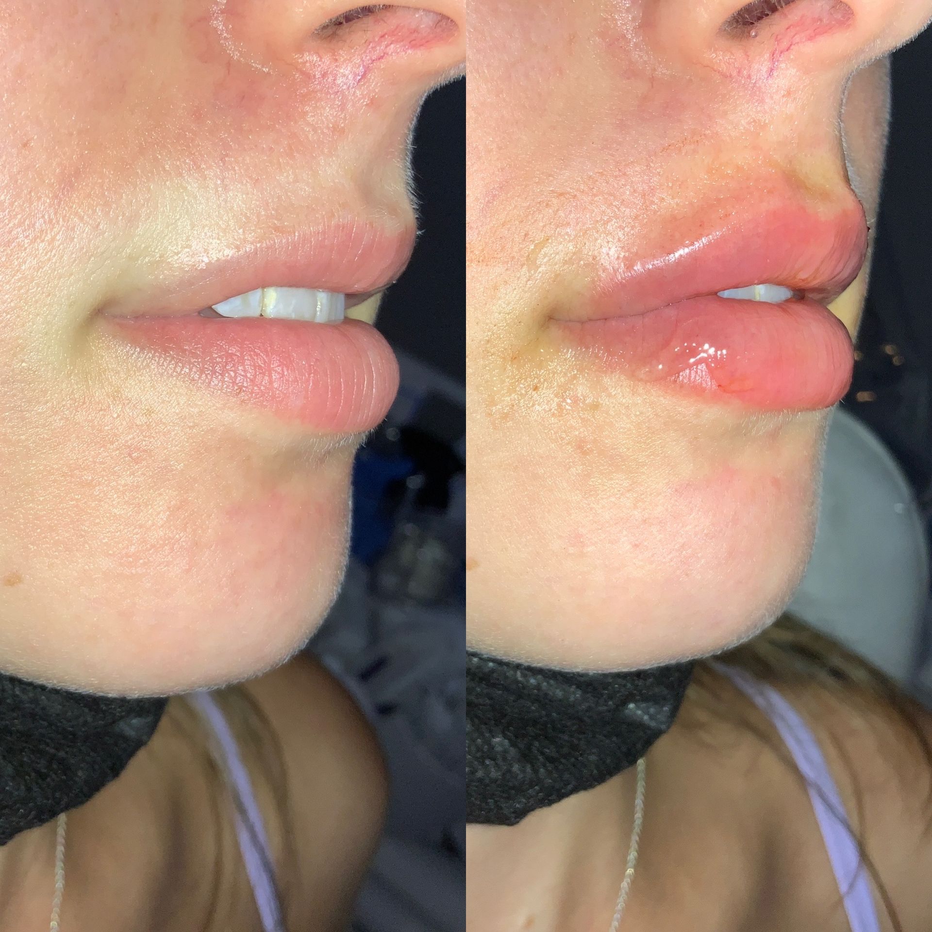 Lip Filler Before and After