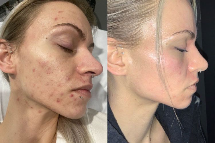 Microdermabrasion Before and After