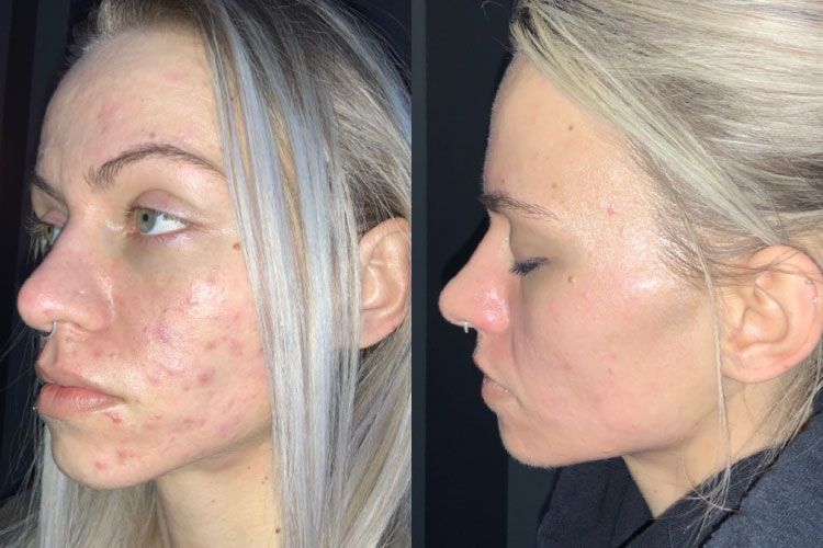 Microdermabrasion Before and After