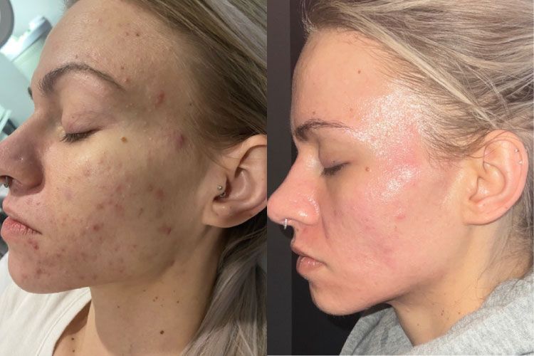 Microdermabrasion Before and After