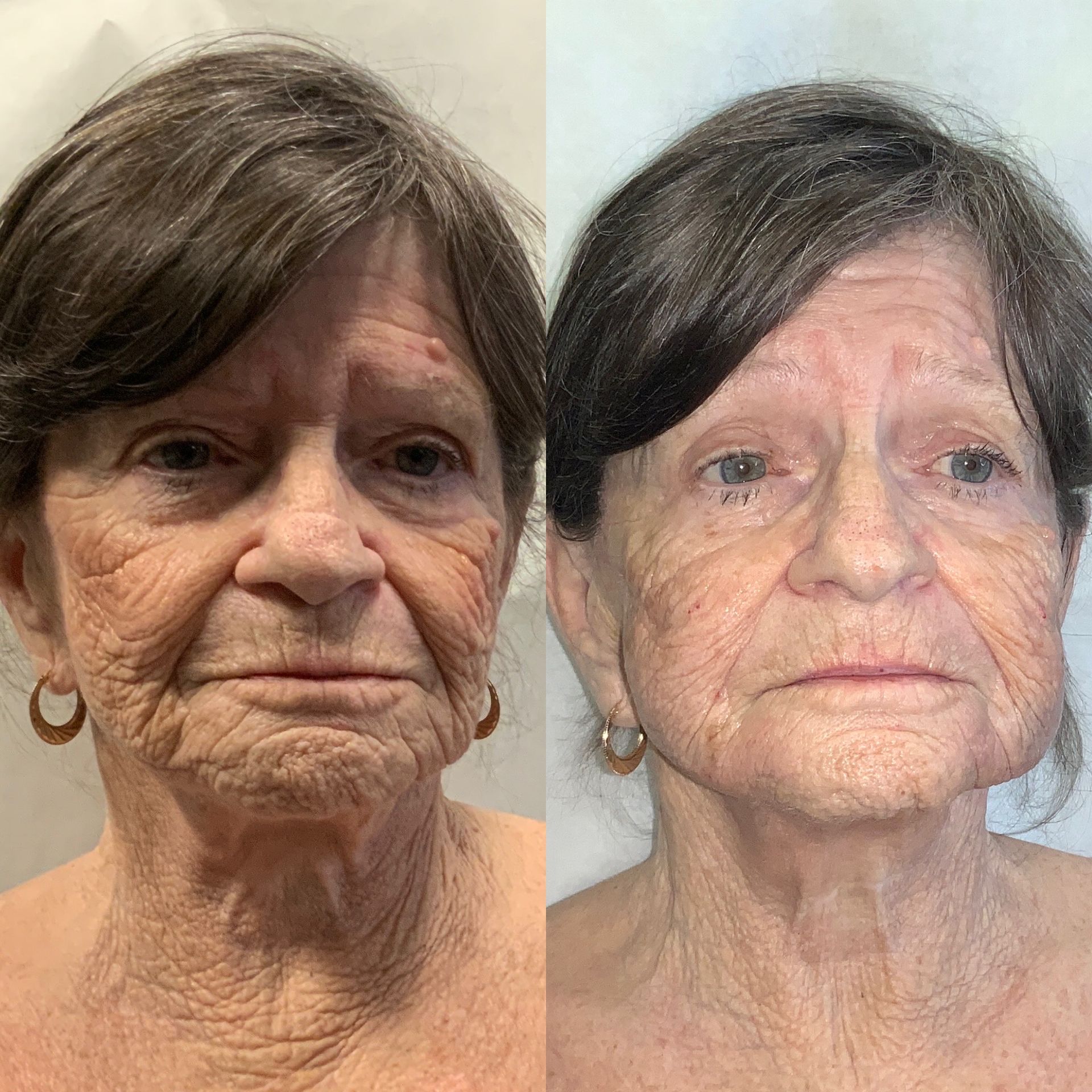 Facial Filler Before and After