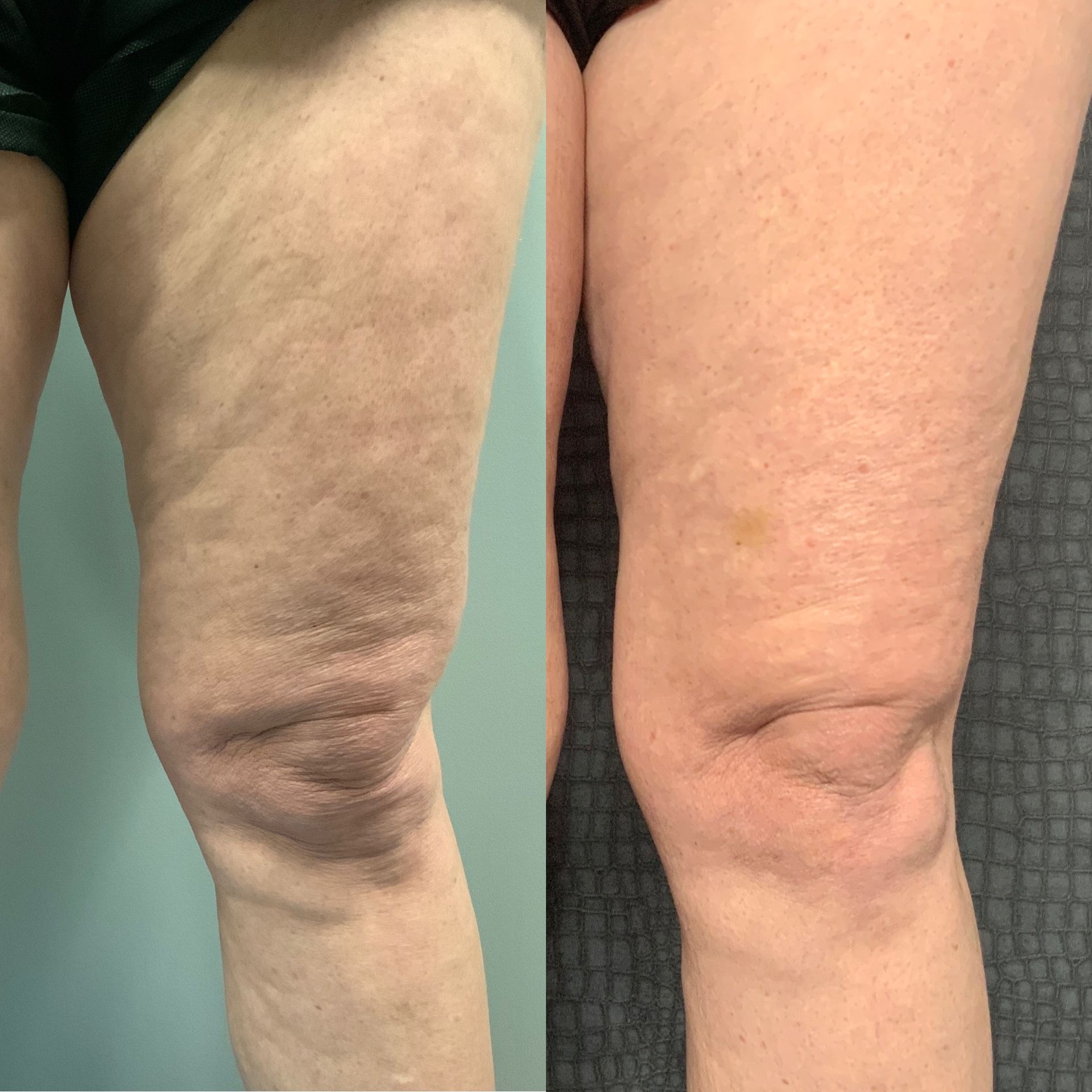 Skin Tightening Before and After