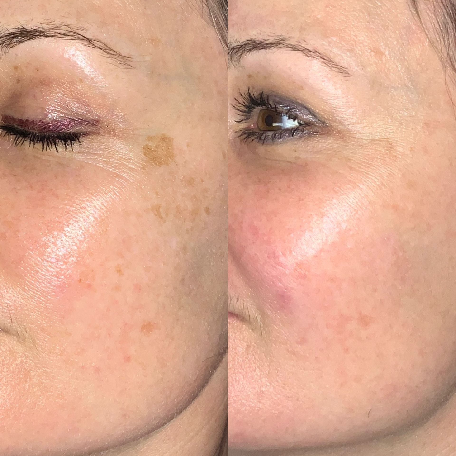 Melasma