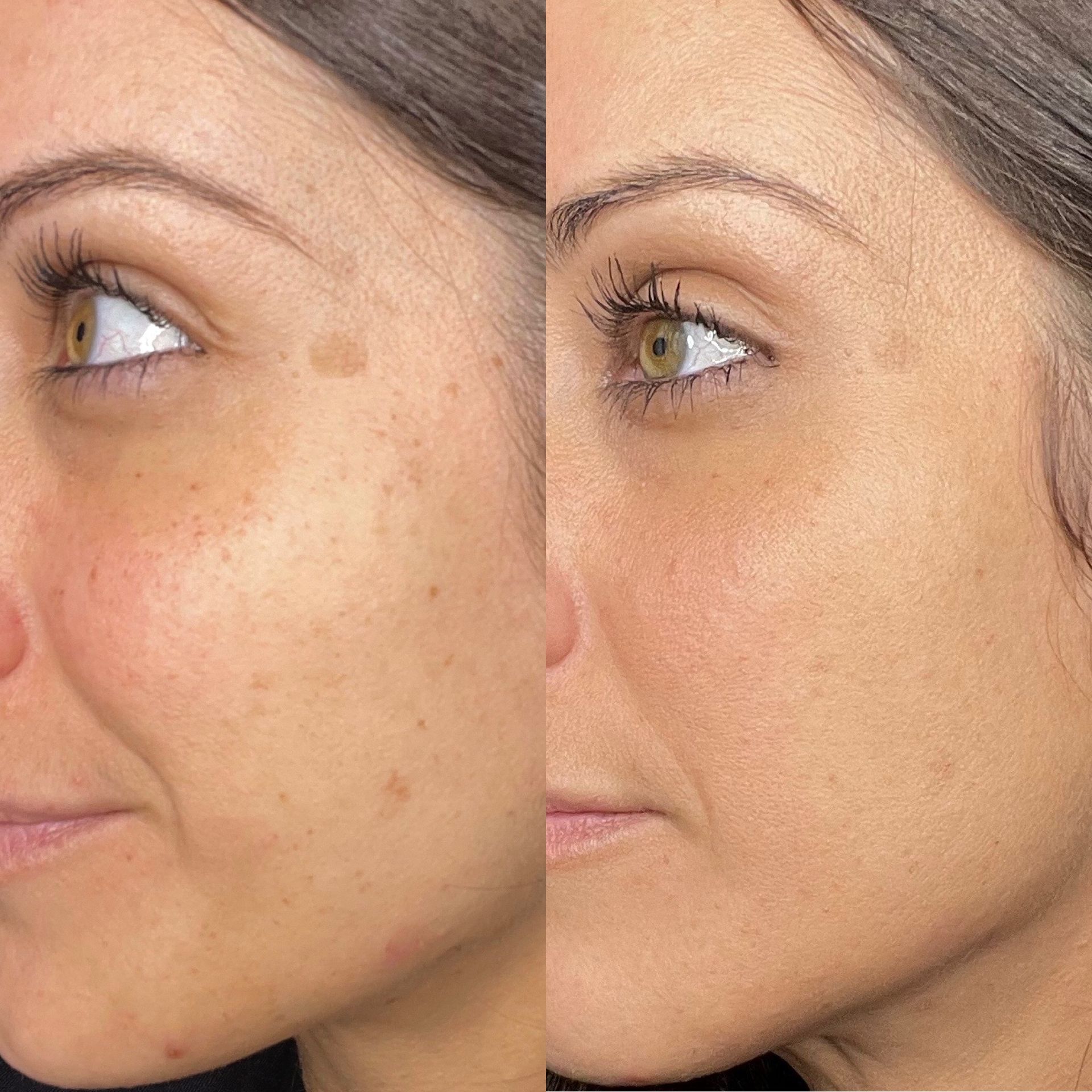 IPL Photofacial Before and After