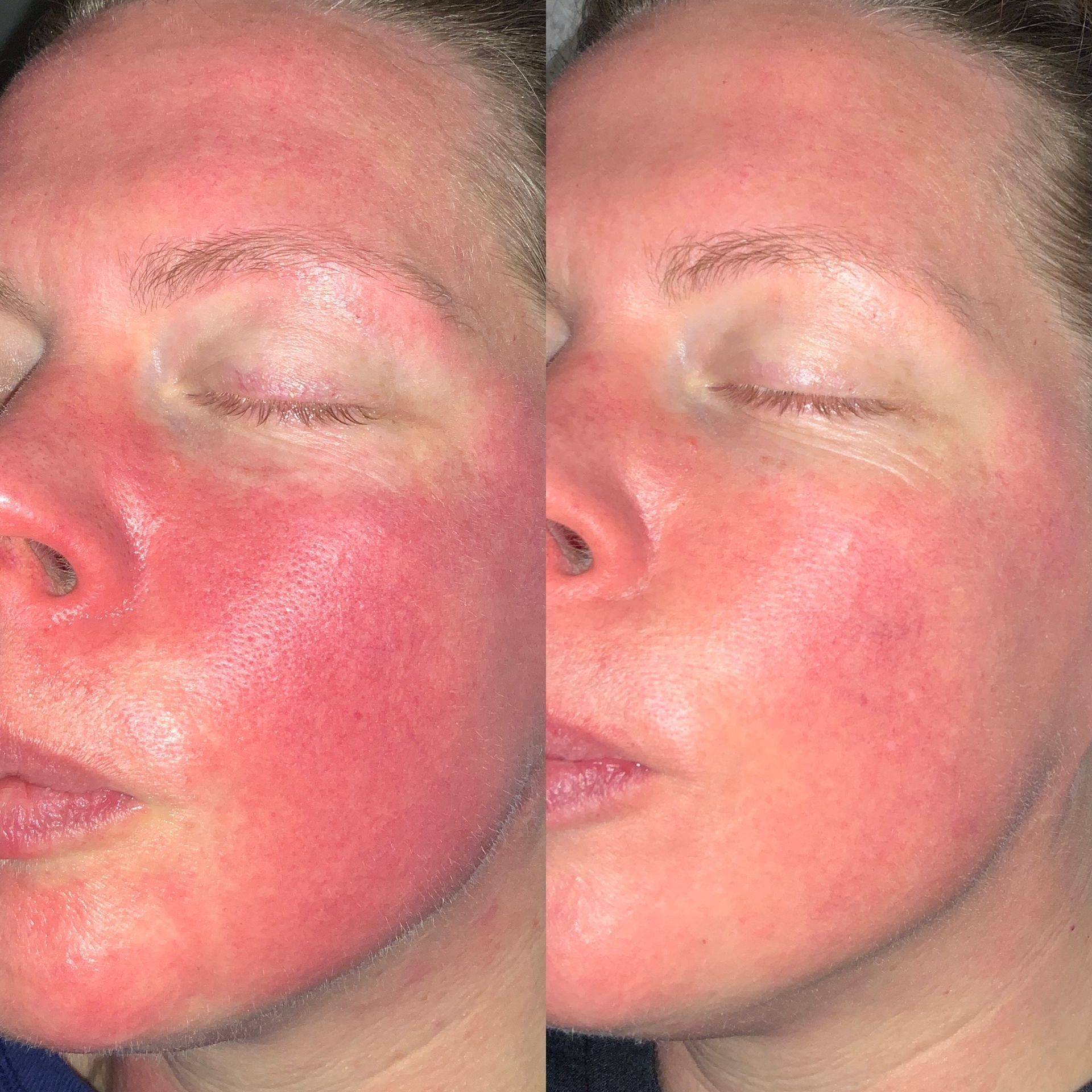 IPL Photofacial Before and After