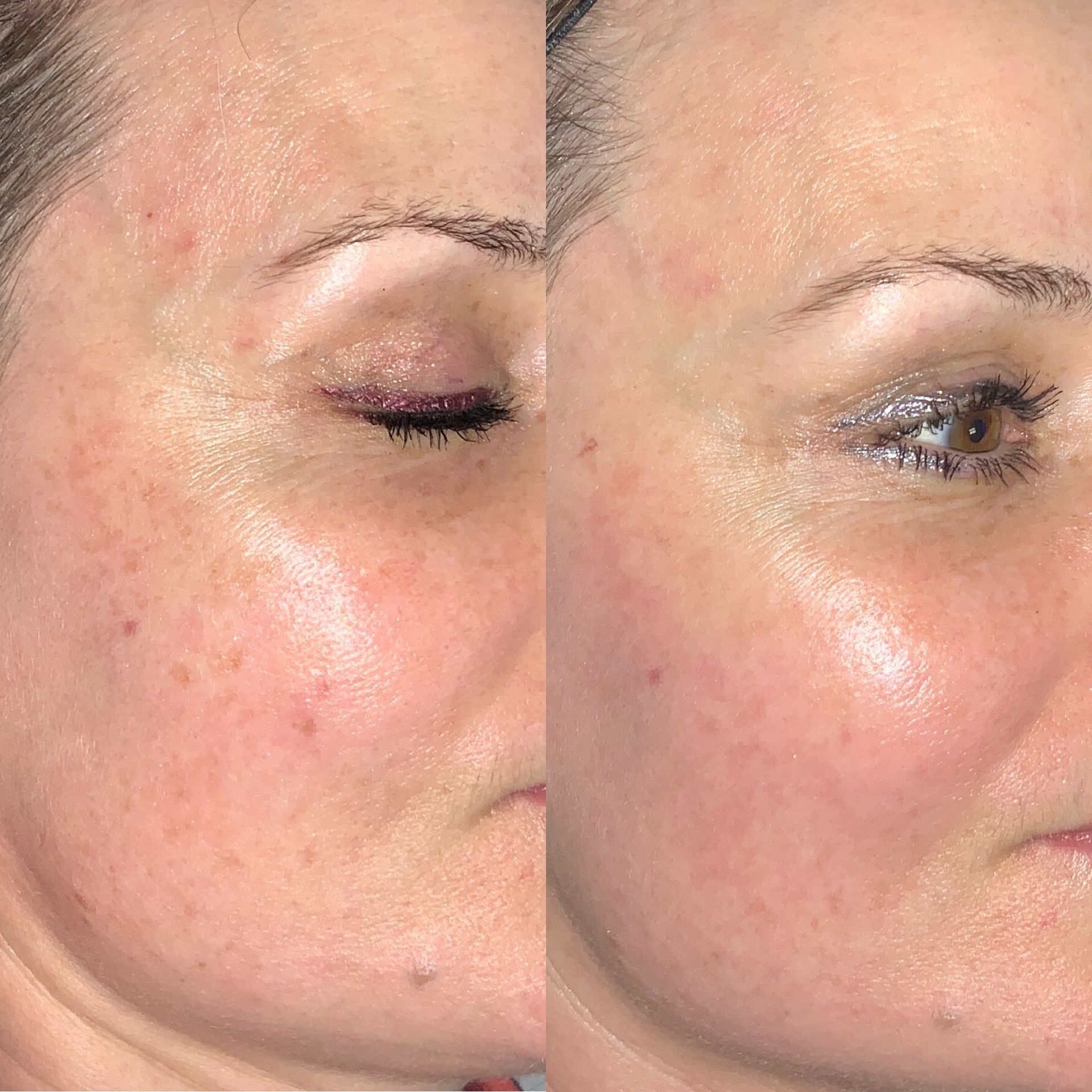 IPL Photofacial Before and After