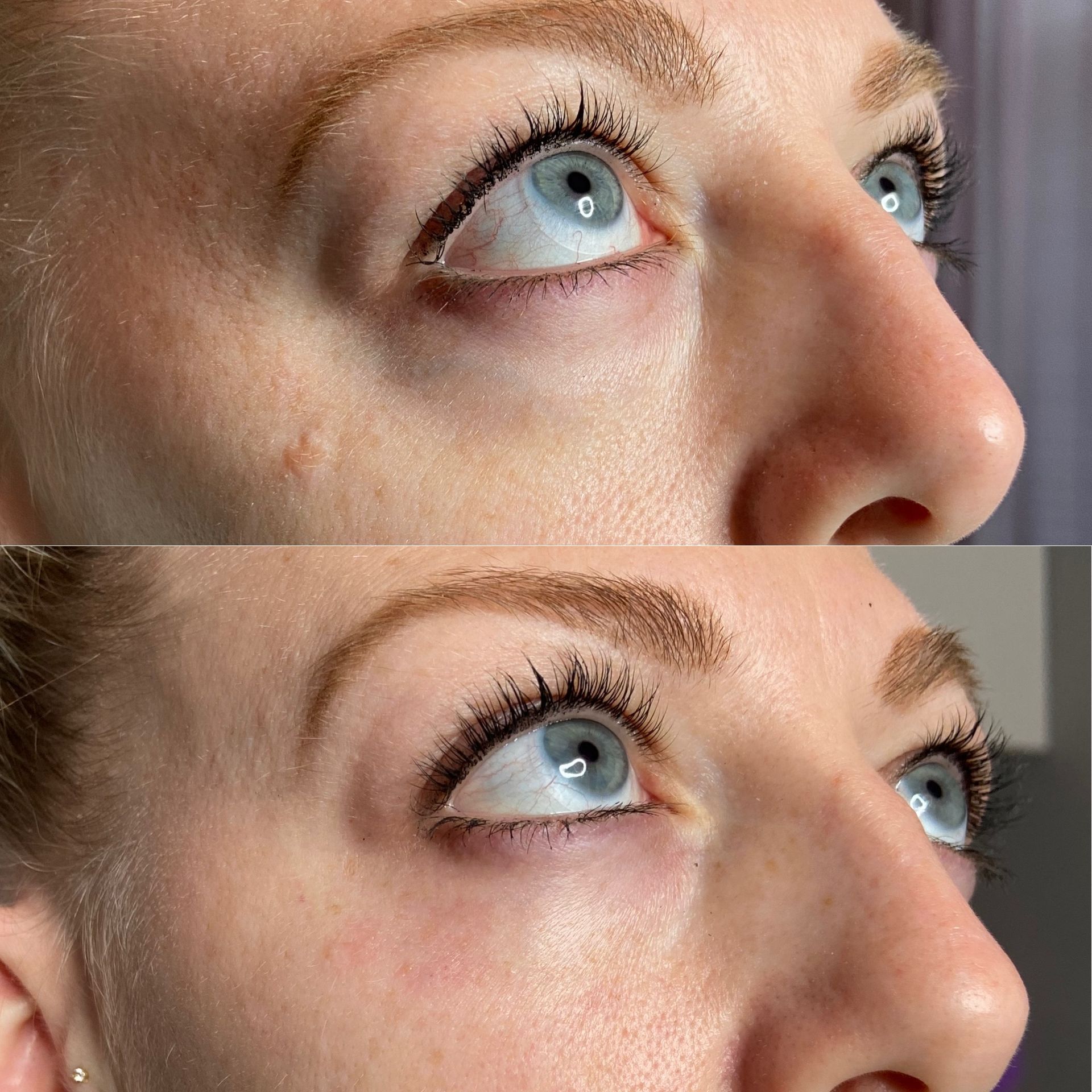 Facial Filler Before and After