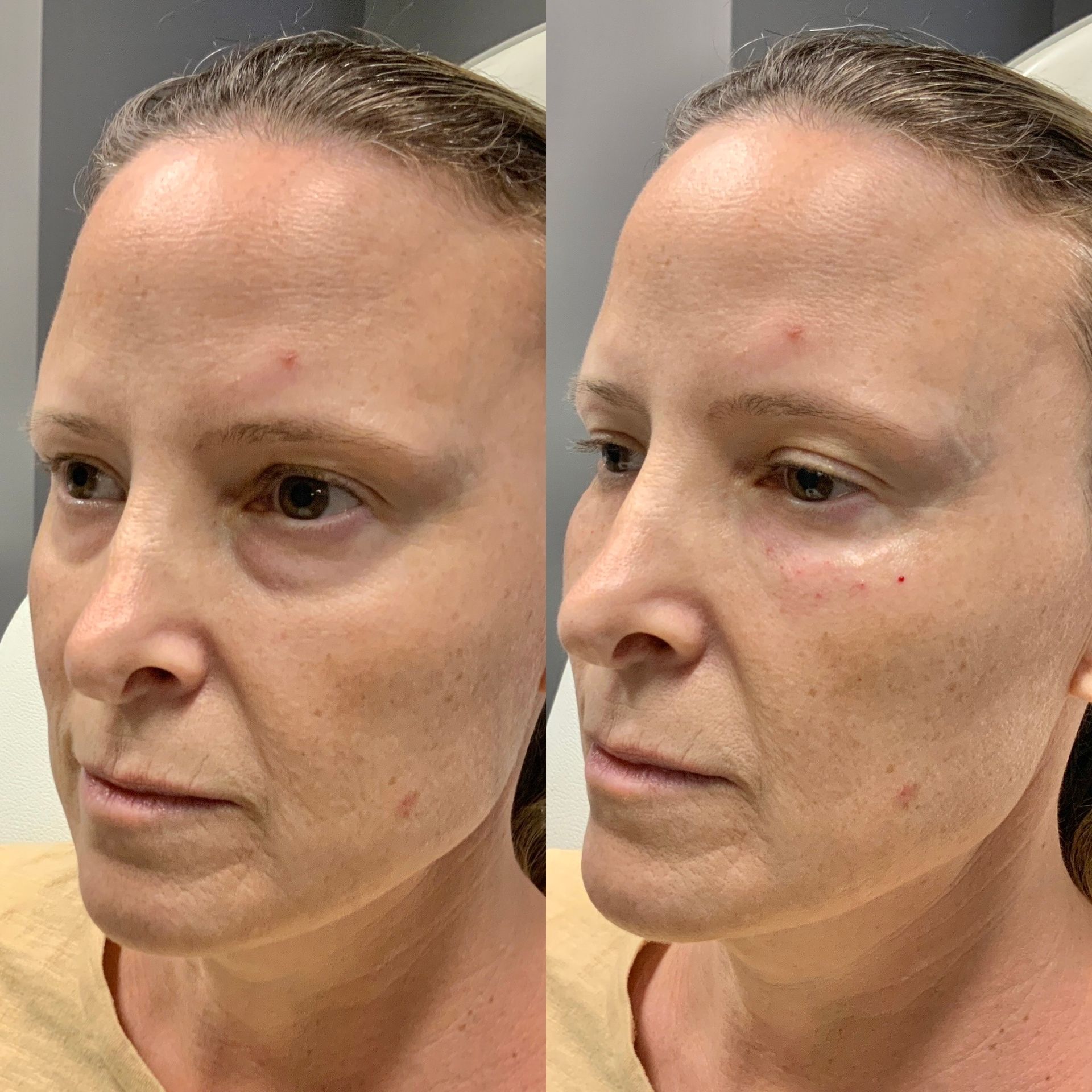 Facial Filler Before and After