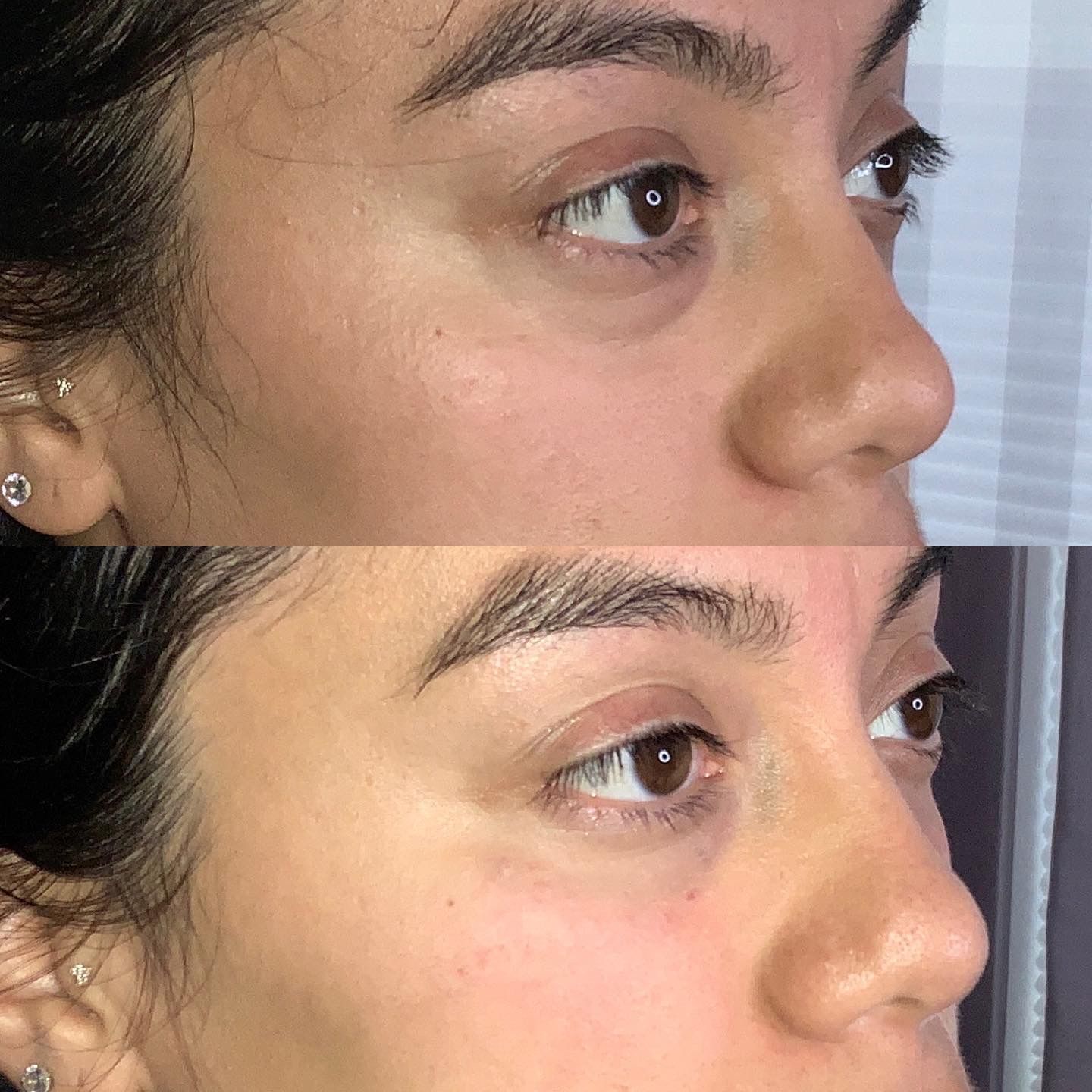 Facial Filler Before and After