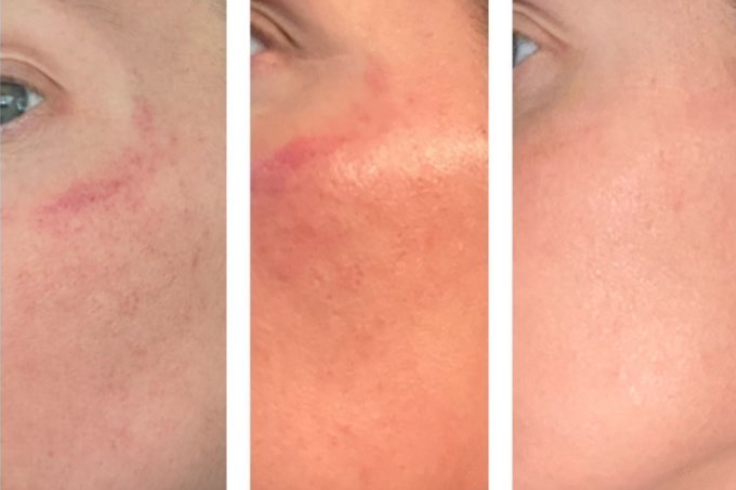 Three images of a person's cheek showing the healing process: initially with prominent redness, then becoming more inflamed, and finally fading to clear skin.