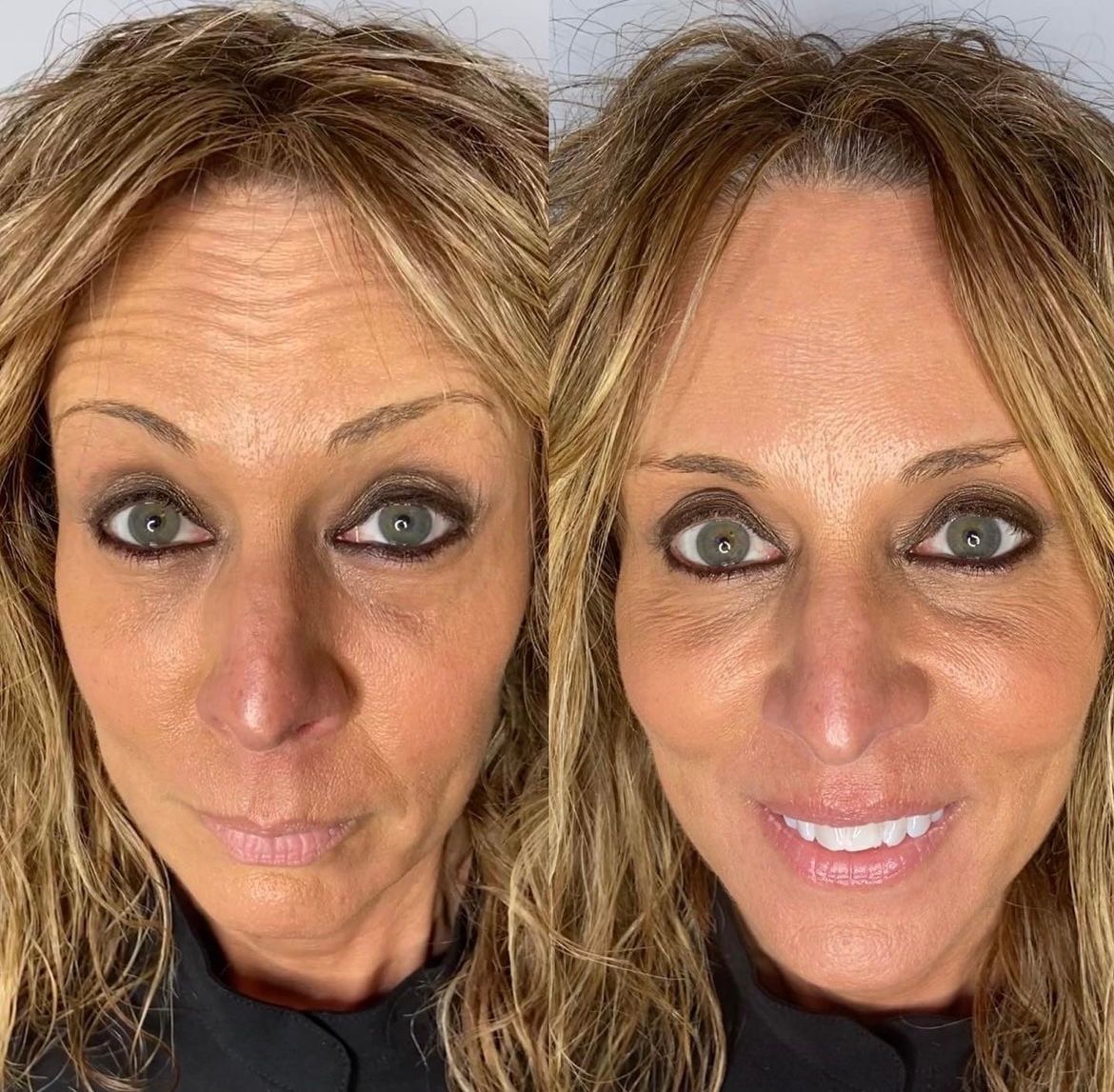 Botox Before and After