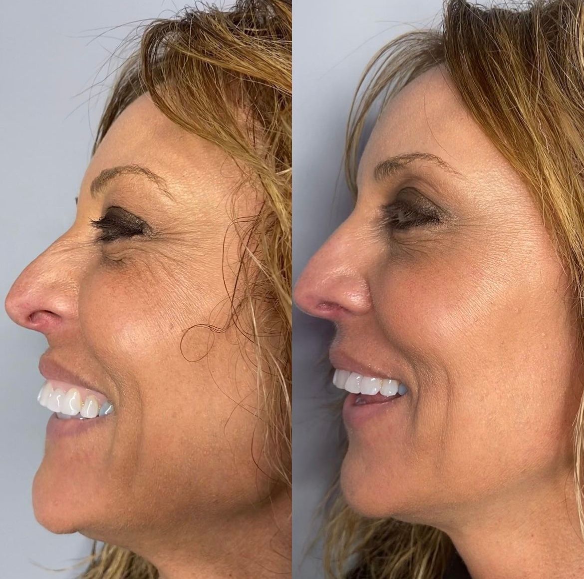 Botox Before and After