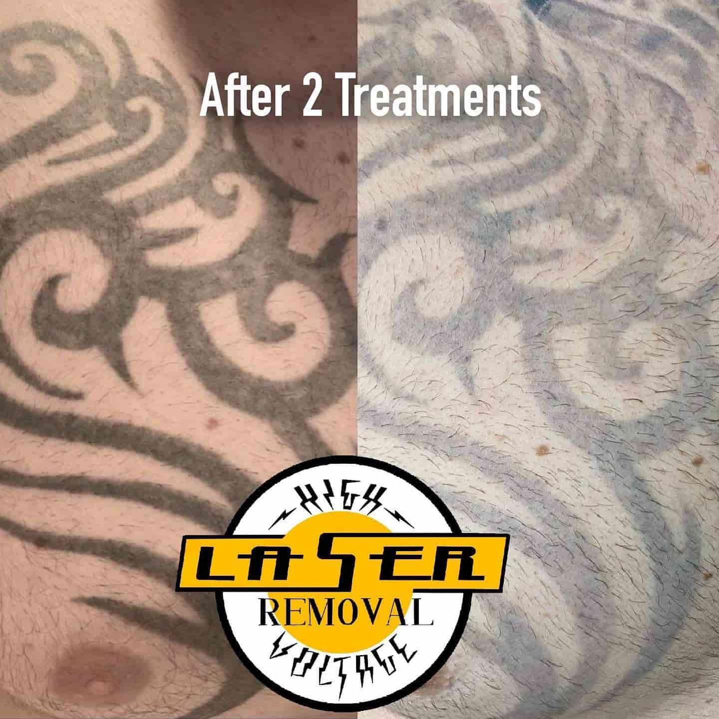 A Picture of a Tattoo Before and After Laser Treatments — Gallery Tattoo in Medowie, NSW