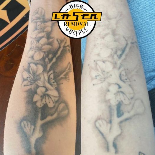 A Tattoo on a Person's Arm Has Been Removed by Laser Removal — Gallery Tattoo in Nelson Bay, NSW