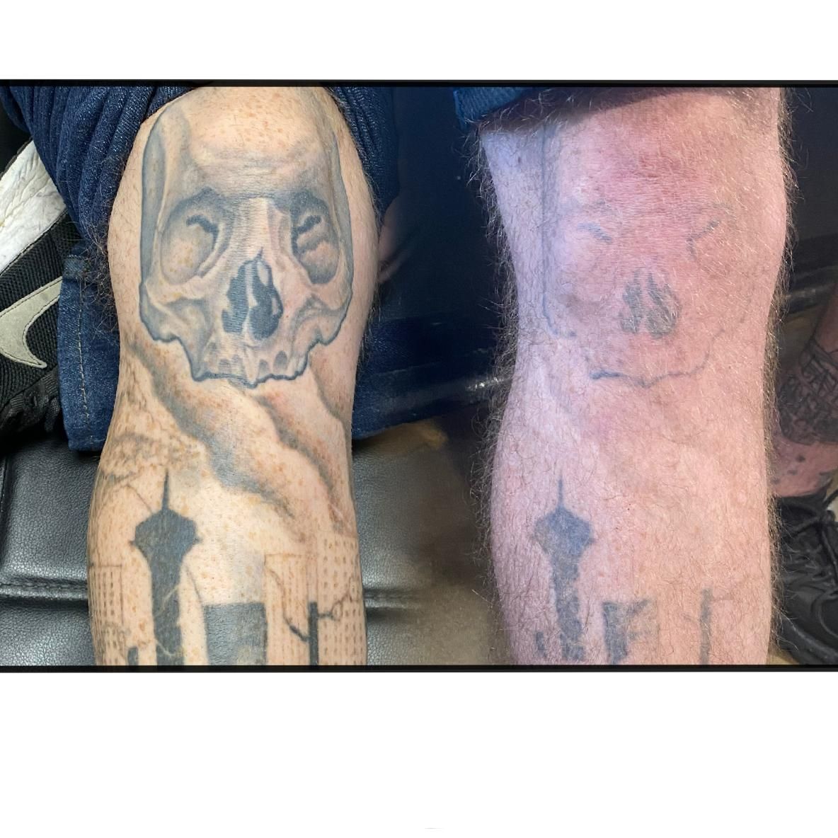A Before and After Picture of a Tattoo Removal on a Person's Leg  — Gallery Tattoo in Medowie, NSW